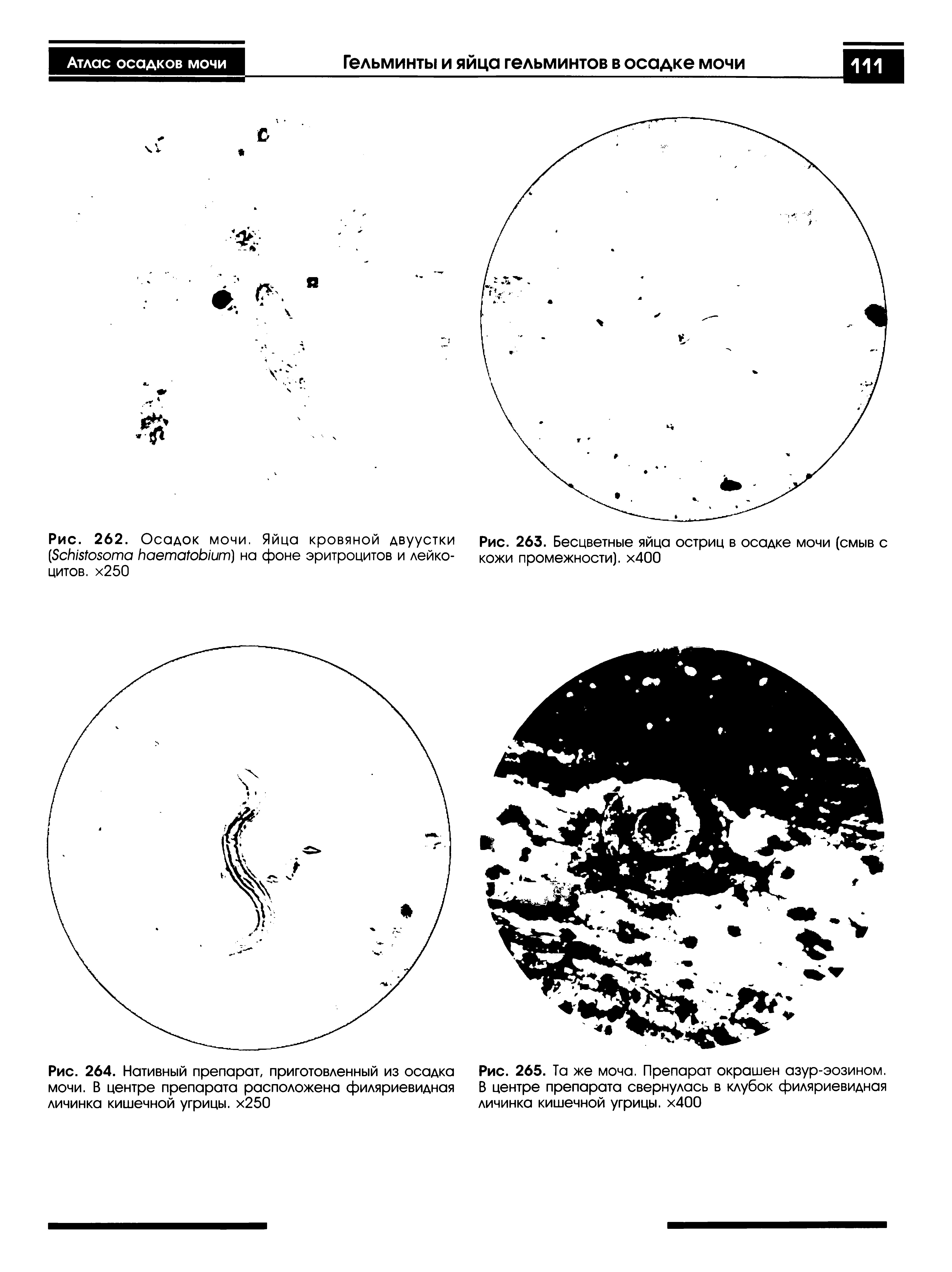 Рис. 262. Осадок мочи. Яйца кровяной двуустки (S ) на фоне эритроцитов и лейкоцитов. х250...