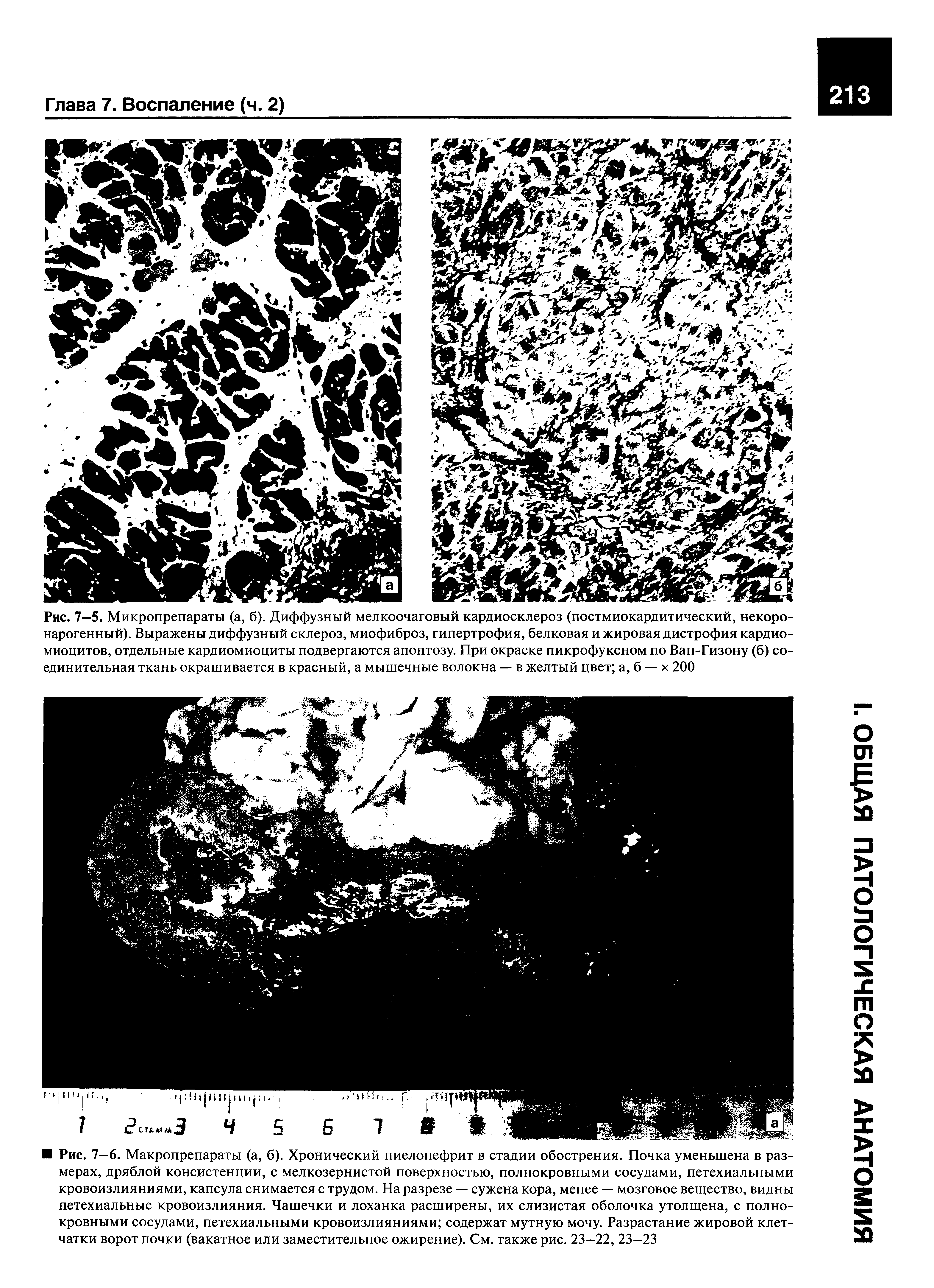 Рис. 7—5. Микропрепараты (а, б). Диффузный мелкоочаговый кардиосклероз (постмиокардитический, некоро-нарогенный). Выражены диффузный склероз, миофиброз, гипертрофия, белковая и жировая дистрофия кардиомиоцитов, отдельные кардиомиоциты подвергаются апоптозу. При окраске пикрофуксном по Ван-Гизону (б) соединительная ткань окрашивается в красный, а мышечные волокна — в желтый цвет а, б — х 200...