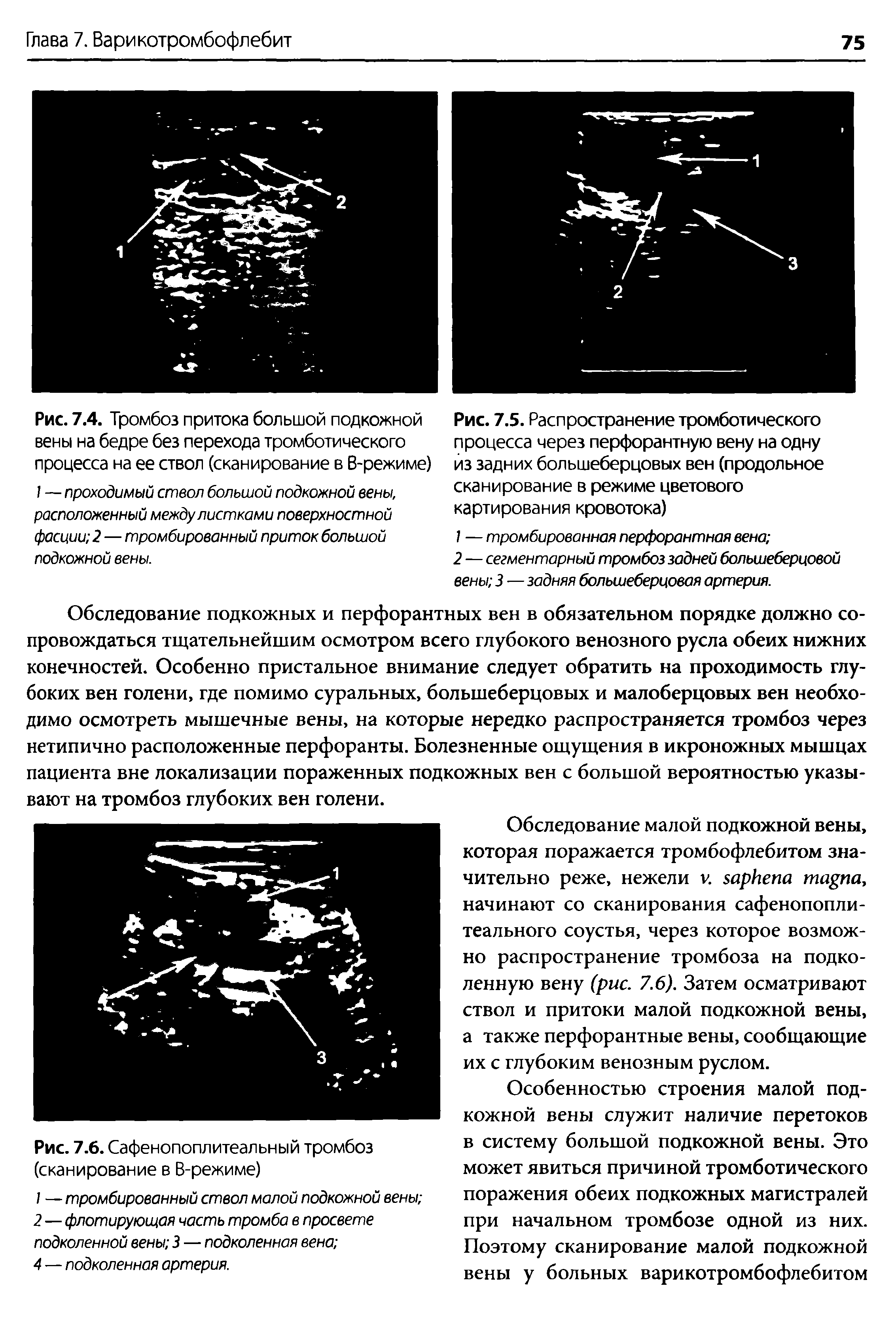 Рис. 7.5. Распространение тромботического процесса через перфорантную вену на одну из задних большеберцовых вен (продольное сканирование в режиме цветового картирования кровотока)...