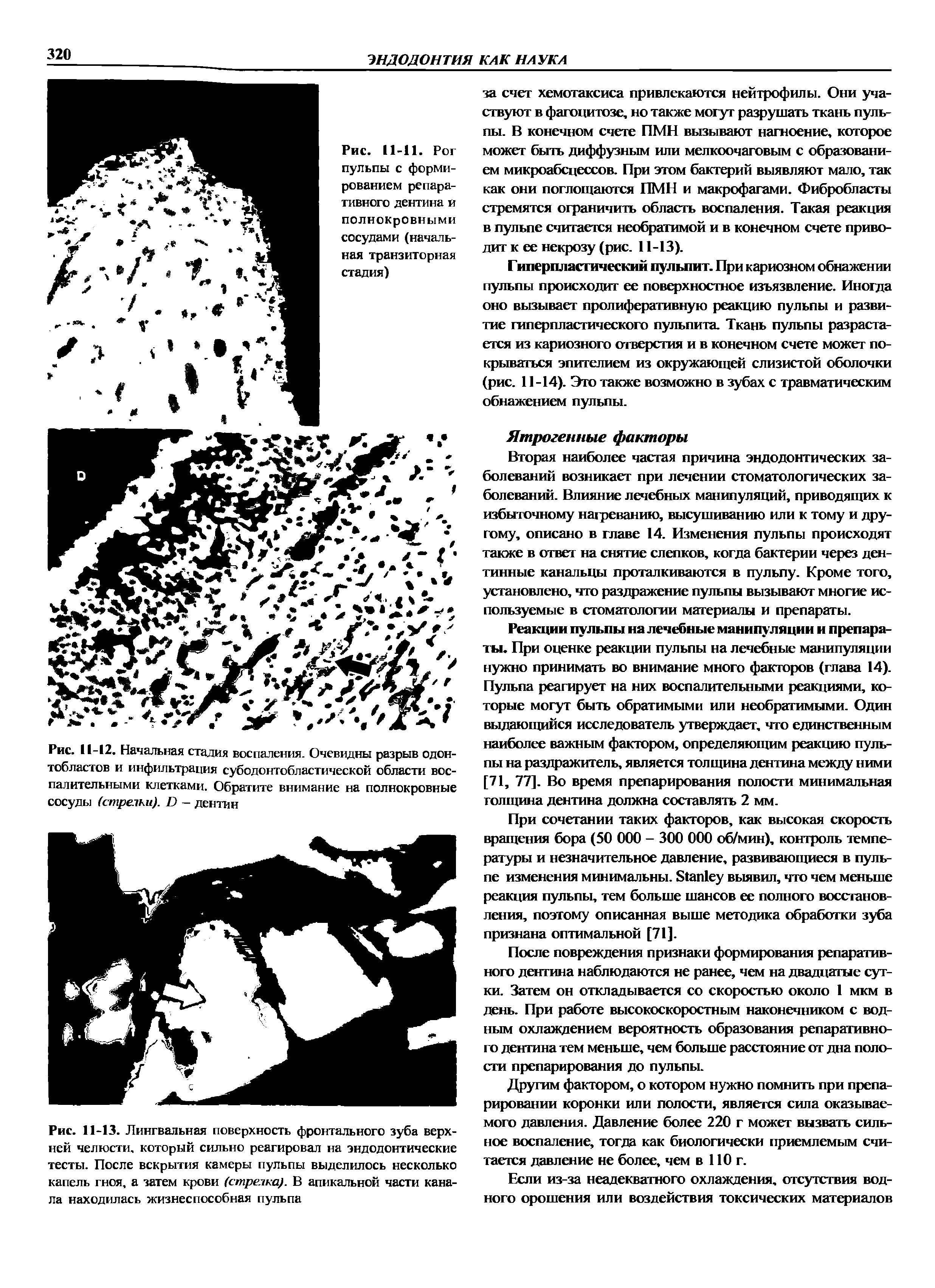 Рис. 11-12. Начальная стадия воспаления. Очевидны разрыв одонтобластов и инфильтрация субодонтобластической области воспалительными клетками. Обратите внимание на полнокровные сосуды (стрелки). И — дентин...