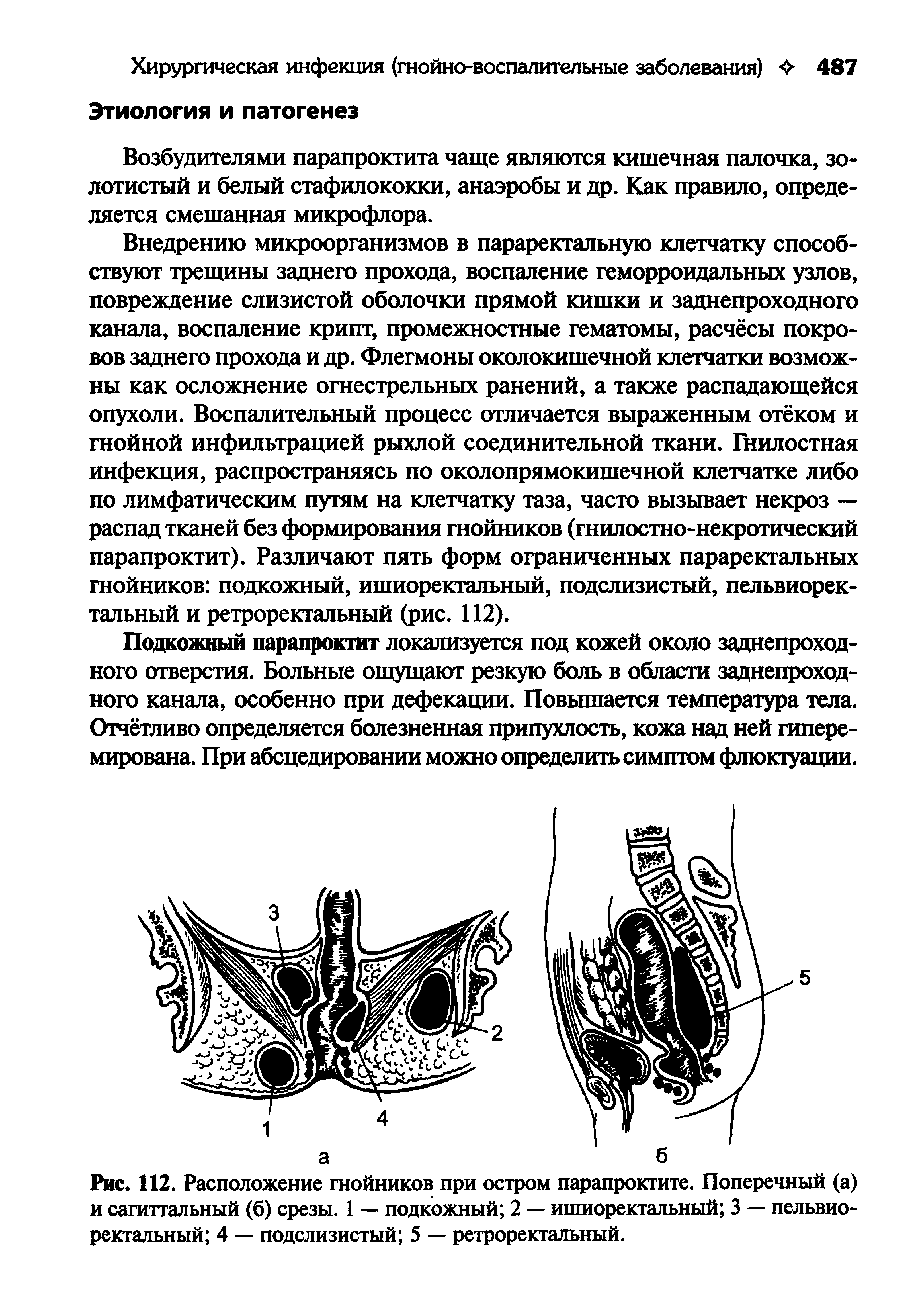 Рис. 112. Расположение гнойников при остром парапроктите. Поперечный (а) и сагиттальный (б) срезы. 1 — подкожный 2 — ишиоректальный 3 — пельвиоректальный 4 — подслизистый 5 — ретроректальный.