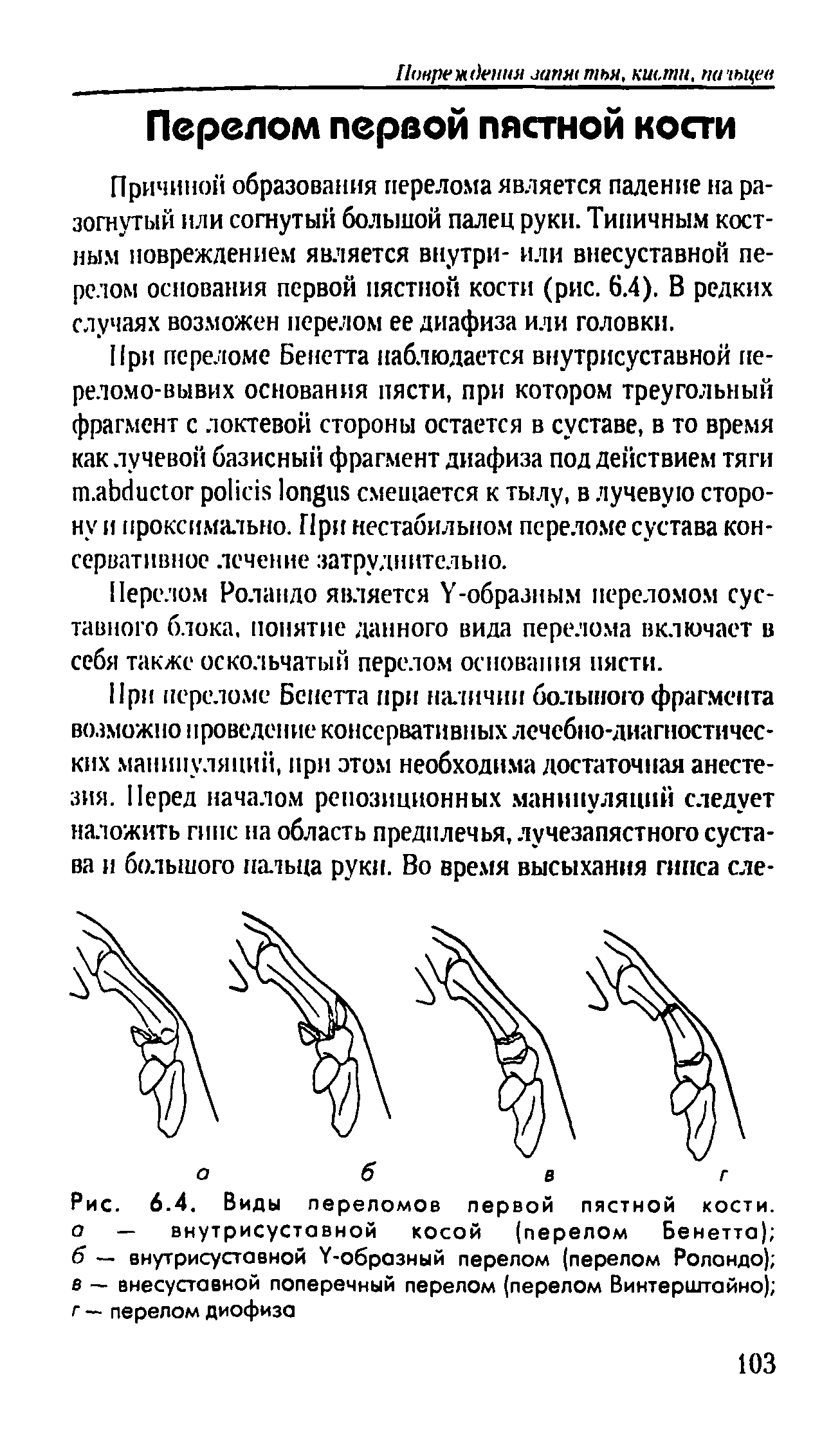 Рис. 6.4. Виды переломов первой пястной кости, о — внутрисуставной косой (перелом Бенетта) б — внутрисуставной У-образный перелом (перелом Роландо) в — внесуставной поперечный перелом (перелом Винтерштайно) г — перелом диофиза...