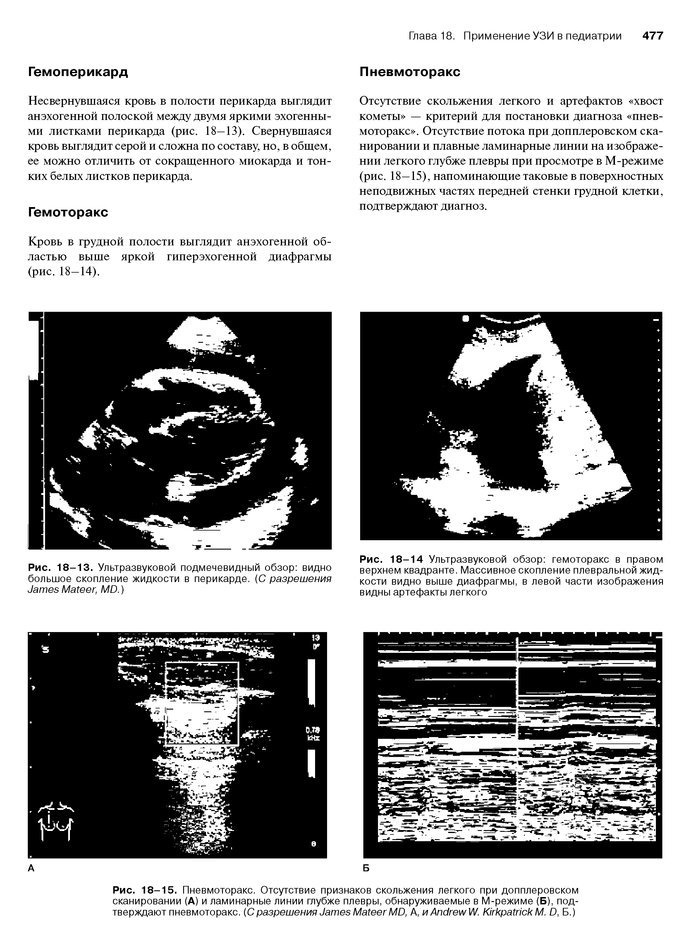 Рис. 18-15. Пневмоторакс. Отсутствие признаков скольжения легкого при допплеровском сканировании (А) и ламинарные линии глубже плевры, обнаруживаемые в М-режиме (Б), подтверждают пневмоторакс. (С разрешения J M MD, А, и A W. K М. D, Б.)...