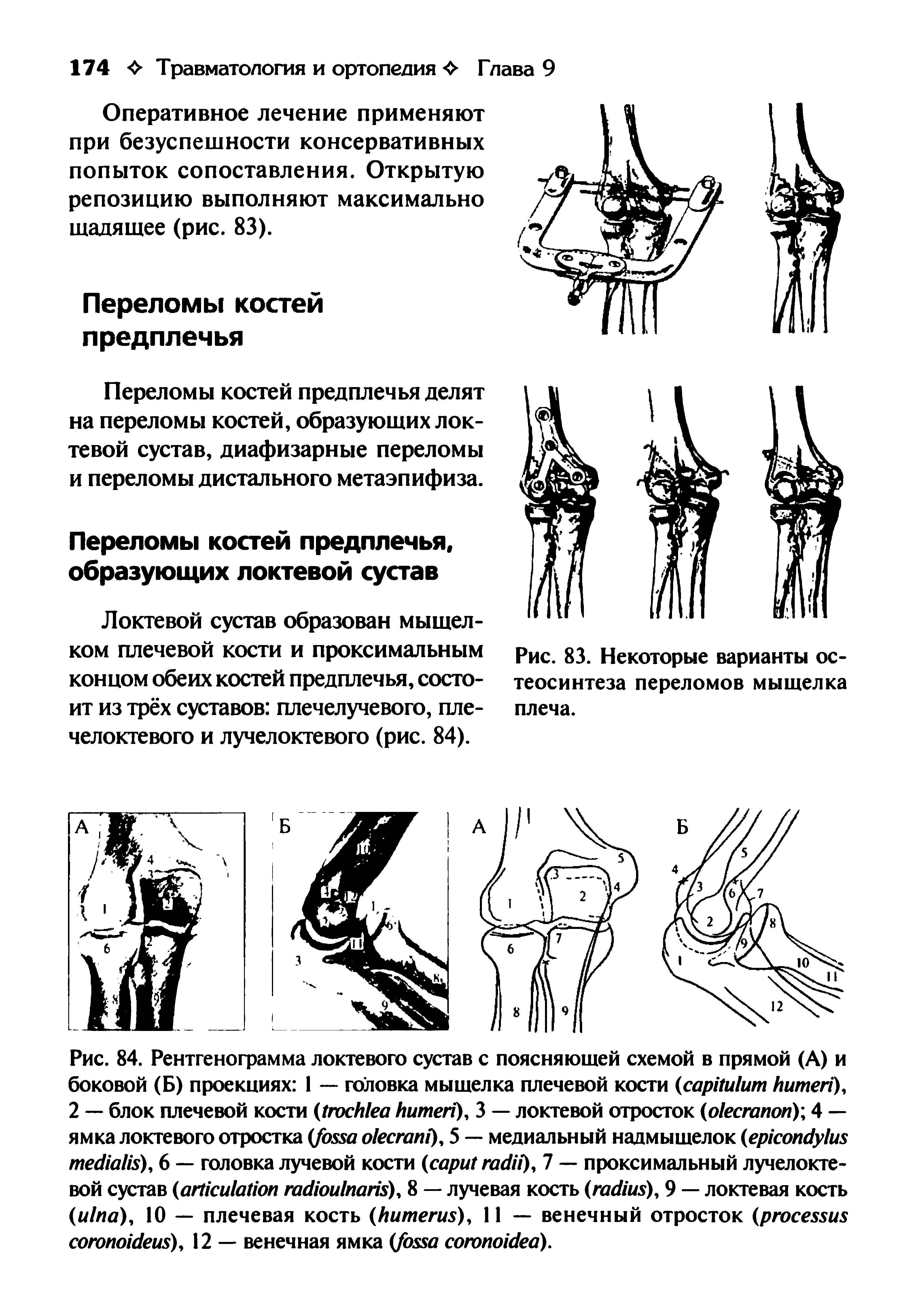 Рис. 83. Некоторые варианты остеосинтеза переломов мыщелка плеча.