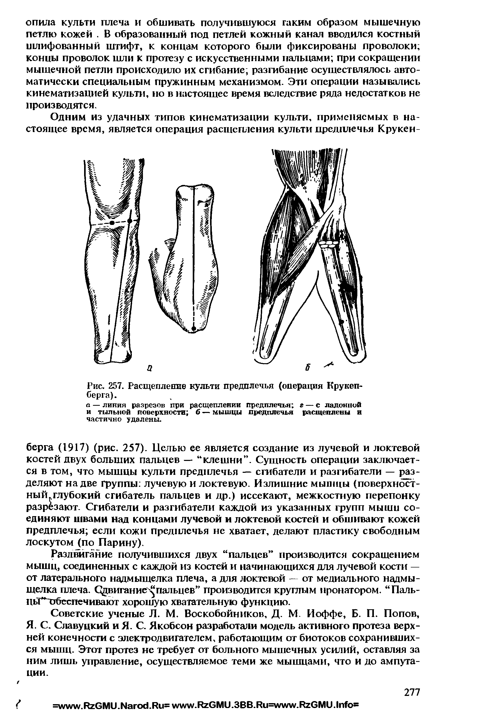 Рис. 257. Расщепление культи предплечья (операция Крукеп-берга).