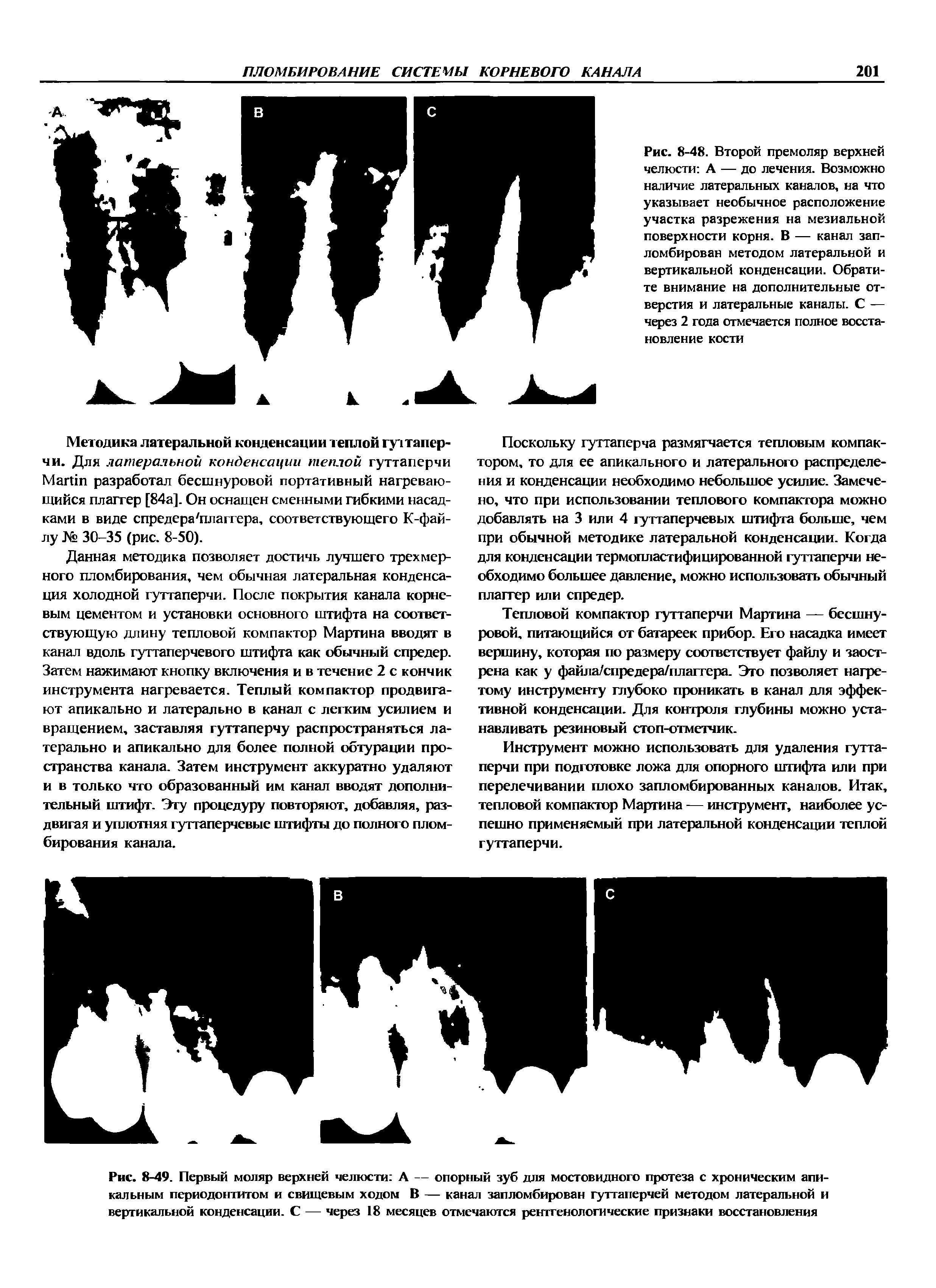 Рис. 8-49. Первый моляр верхней челюсти А — опорный зуб для мостовидного протеза с хроническим апикальным периодонтитом и свищевым ходом В — канал запломбирован гуттаперчей методом латеральной и вертикальной конденсации. С — через 18 месяцев отмечаются рентгенологические признаки восстановления...