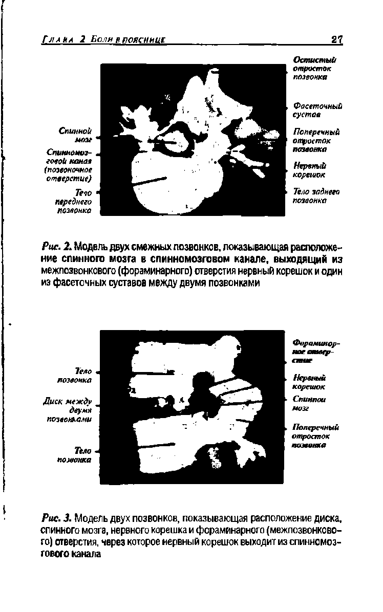 Рис. 3. Модель двух позвонков, показывающая расположение диска, спинного мозга, нервного корешка и фораминарного (межпозвонкового) отверстия, через которое нервный корешок выходит из спинномозгового канала...