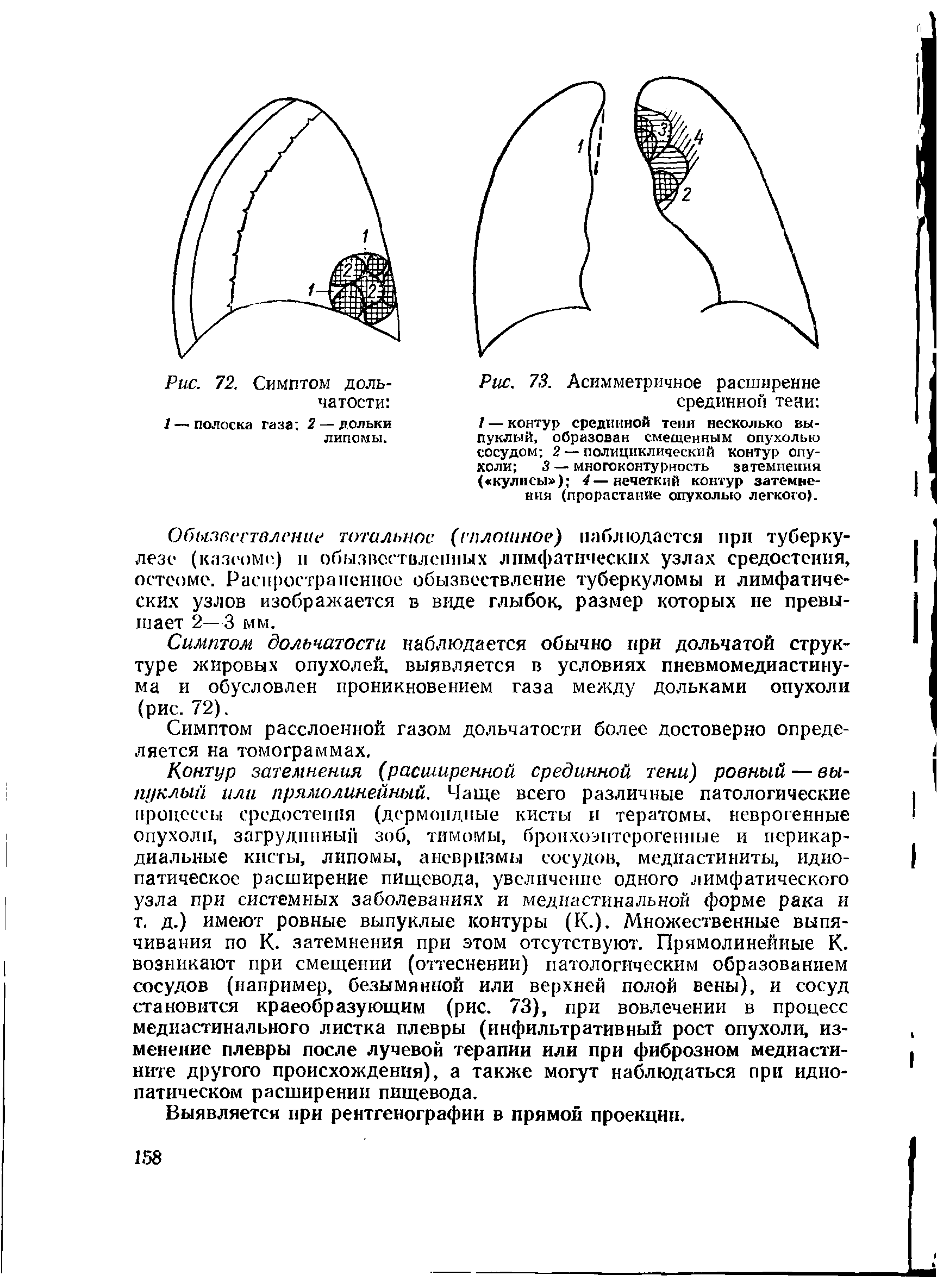 Рис. 73. Асимметричное расширение срединной тени / — контур срединной тени несколько выпуклый, образован смещенным опухолью сосудом 2 — полициклический контур опухоли 3 — многоконтурность затемнения ( кулисы ) 4—нечеткий контур затемнения (прорастание опухолыо легкого).