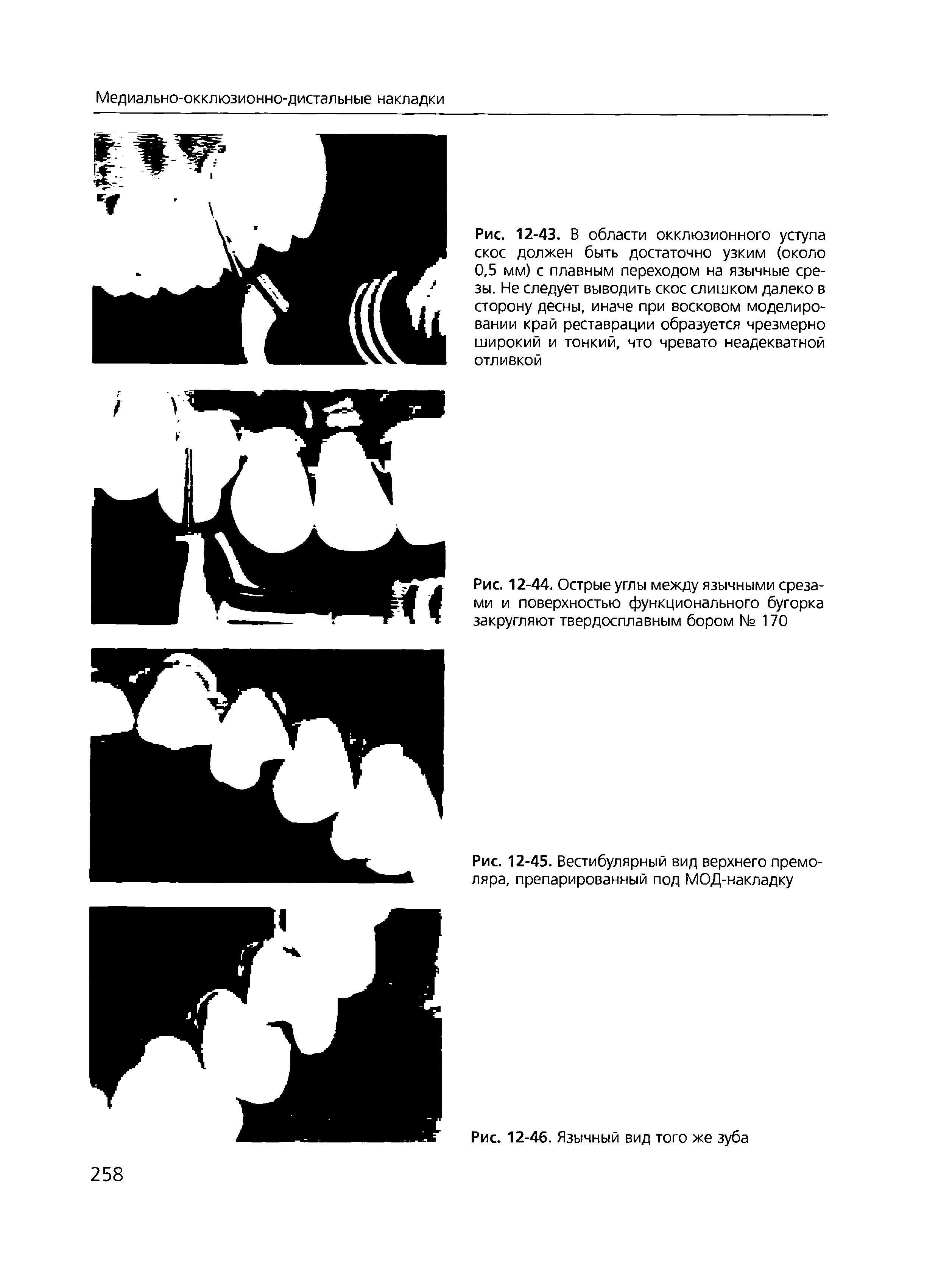 Рис. 12-43. В области окклюзионного уступа скос должен быть достаточно узким (около 0,5 мм) с плавным переходом на язычные срезы. Не следует выводить скос слишком далеко в сторону десны, иначе при восковом моделировании край реставрации образуется чрезмерно широкий и тонкий, что чревато неадекватной отливкой...