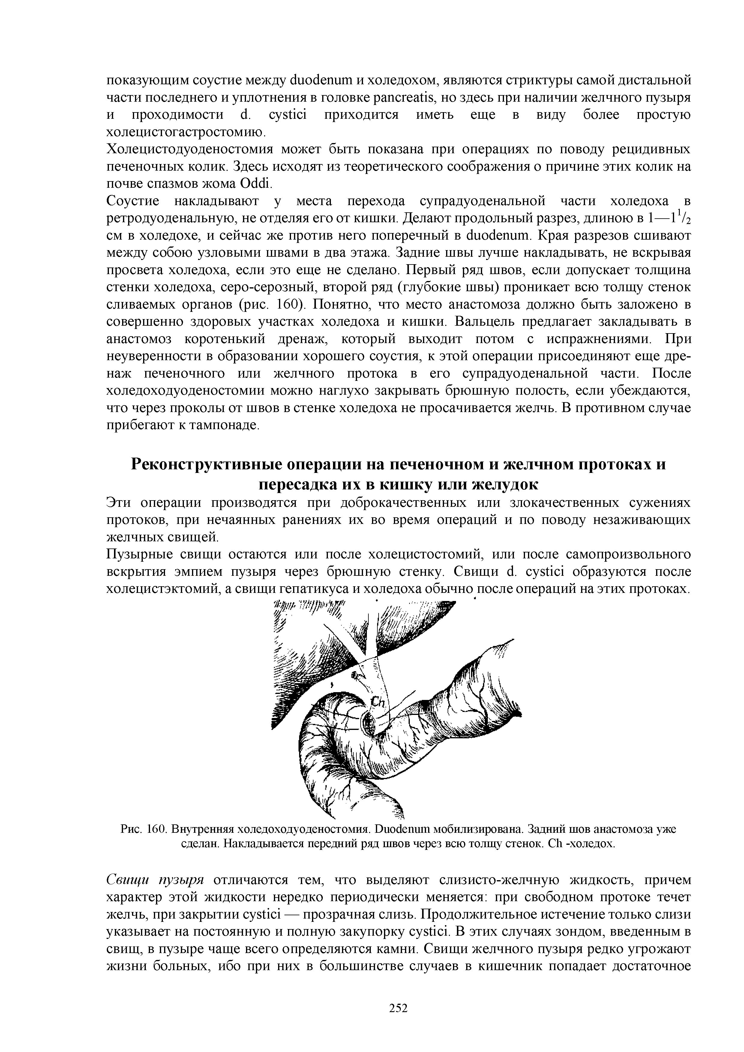 Рис. 160. Внутренняя холедоходуоденостомия. D мобилизирована. Задний шов анастомоза уже сделан. Накладывается передний ряд швов через всю толщу стенок. C -холедох.