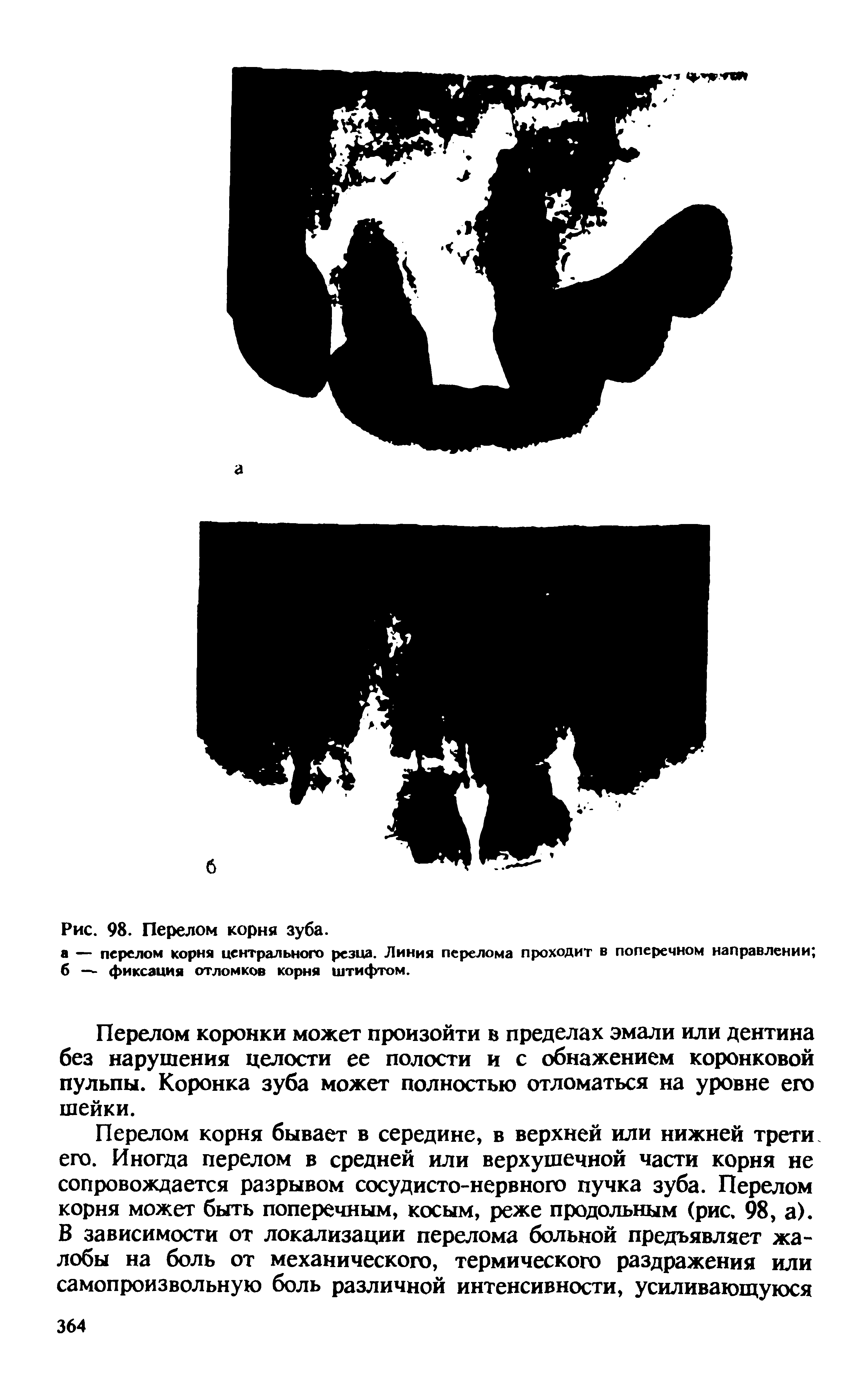 Рис. 98. Перелом корня зуба, а — перелом корня центрального резца. Линия перелома проходит в поперечном направлении б — фиксация отломков корня штифтом.