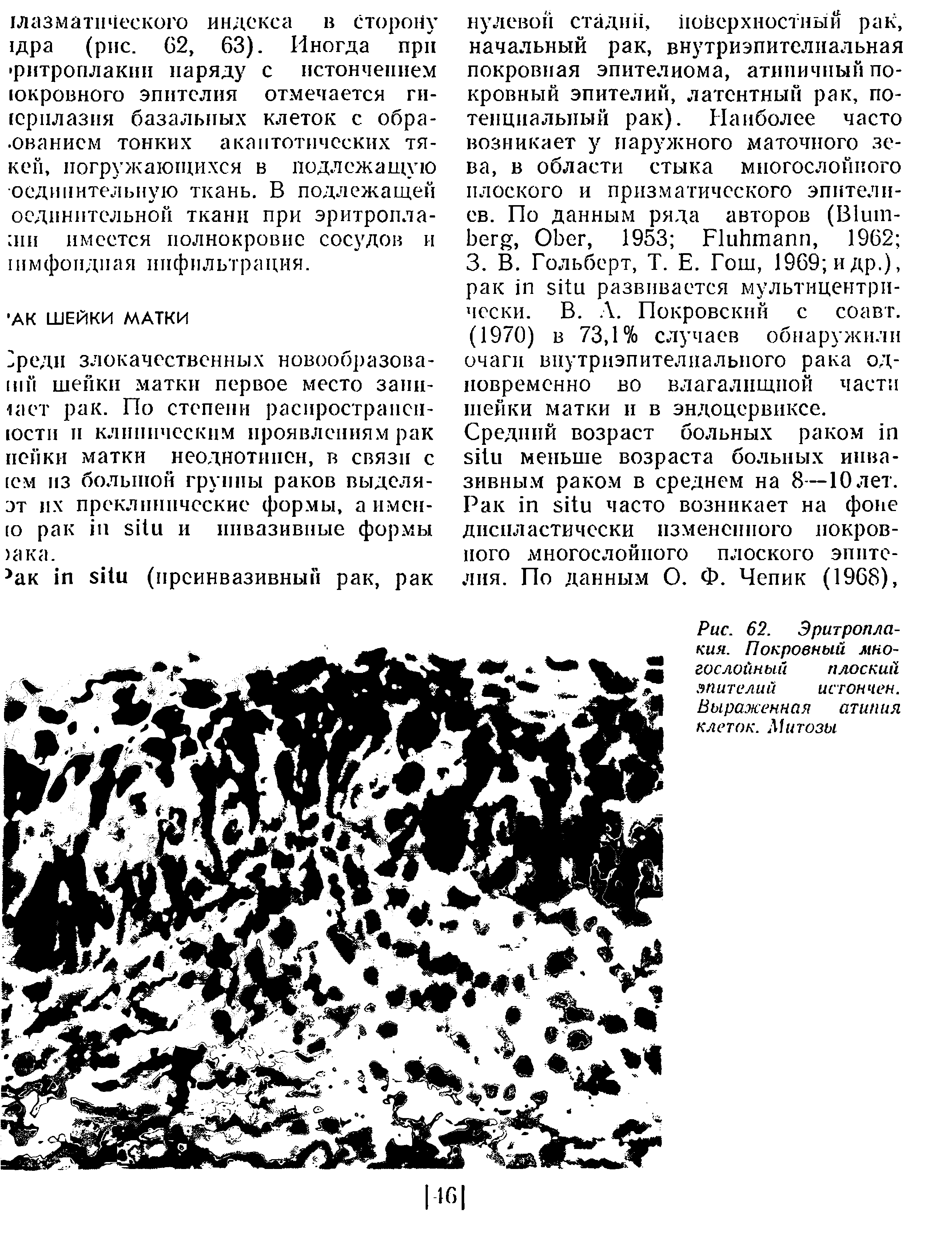 Рис. 62. Эритропла-кия. Покровный многослойный плоский эпителий истончен. Выраженная атипия клеток. Митозы...