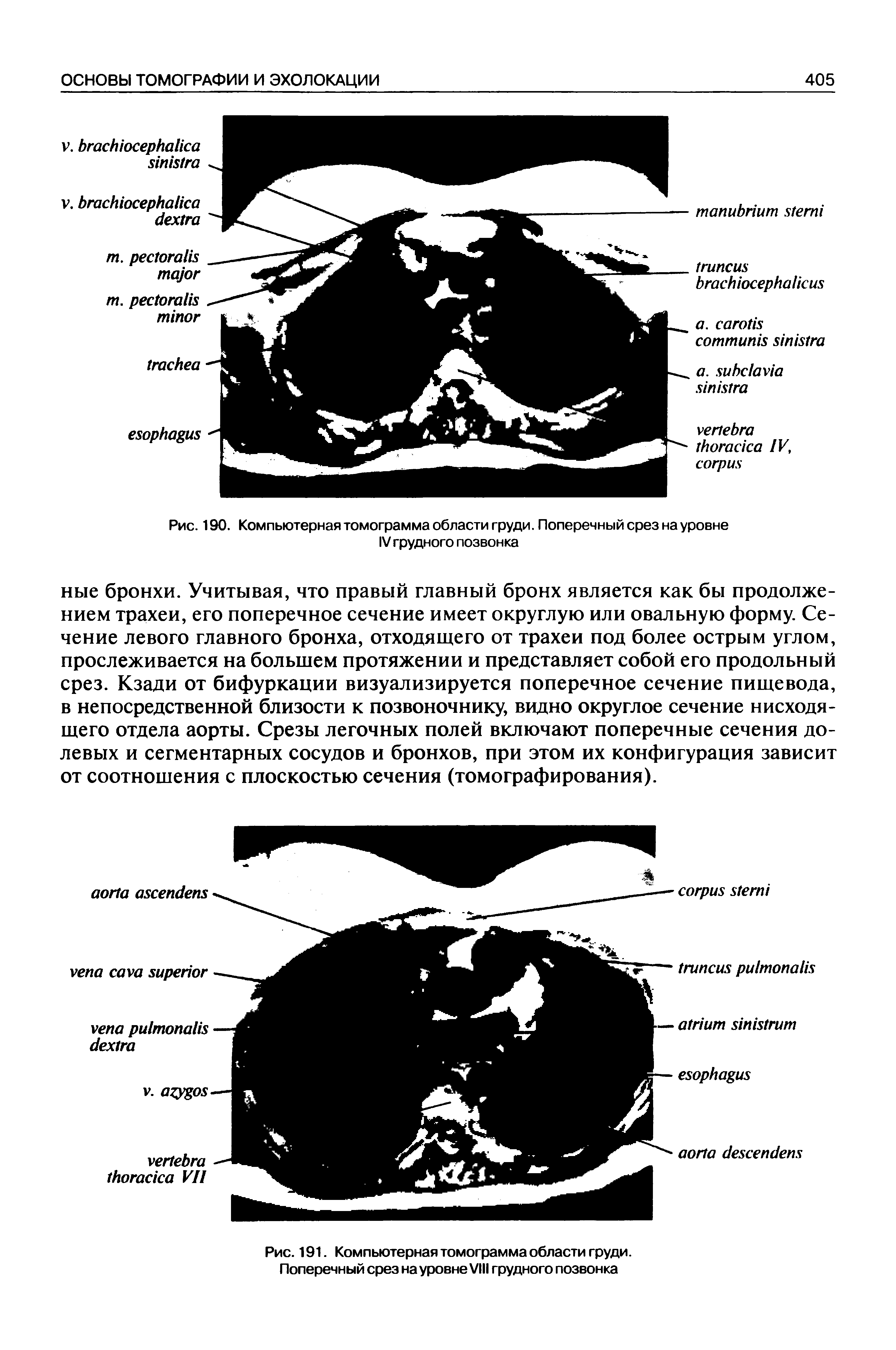 Рис. 190. Компьютерная томограмма области груди. Поперечный срез на уровне IV грудного позвонка...