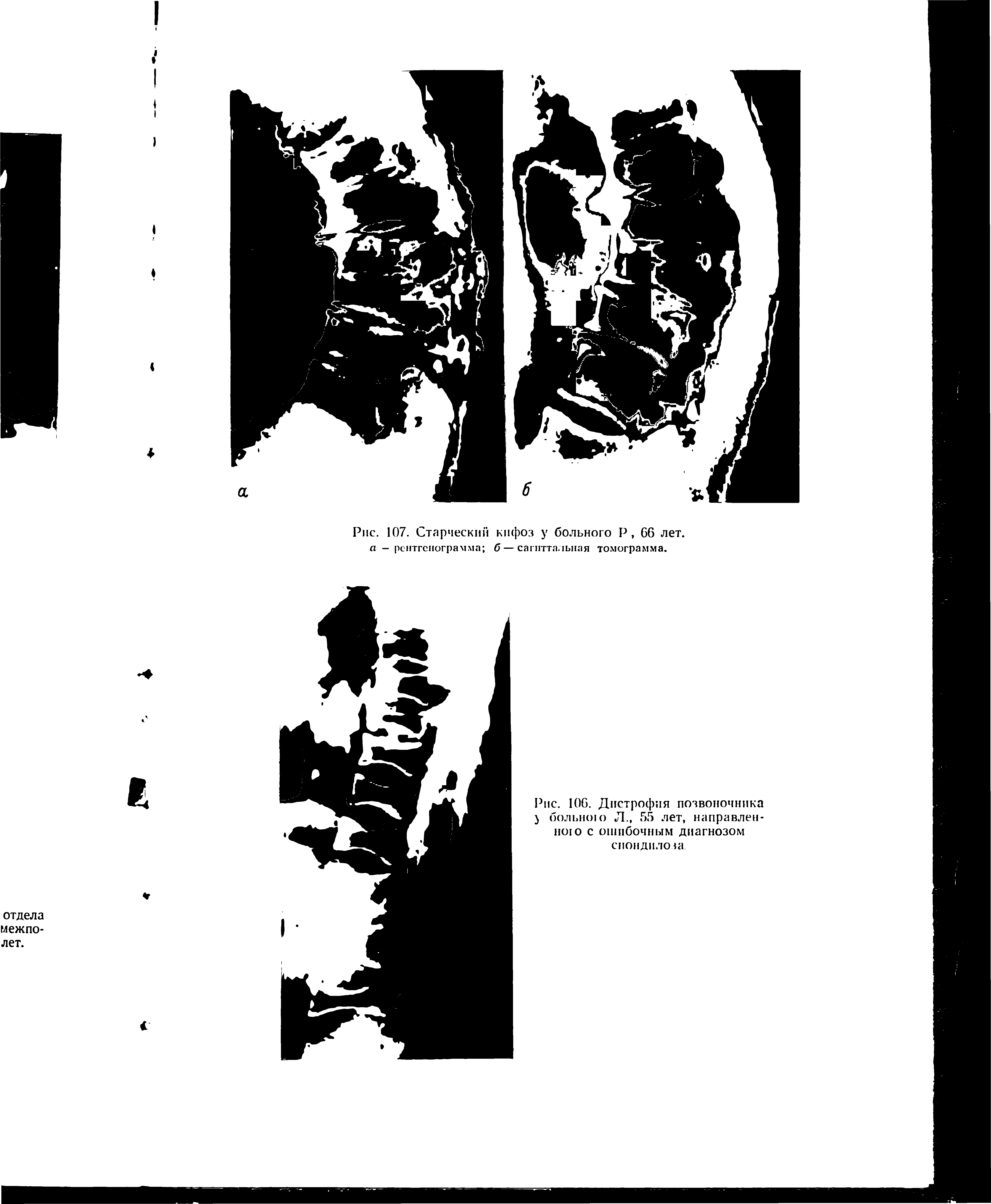 Рис. 107. Старчески кифоз у больного Р, 66 лет. а — рентгенограмма б — сагиттальная томограмма.