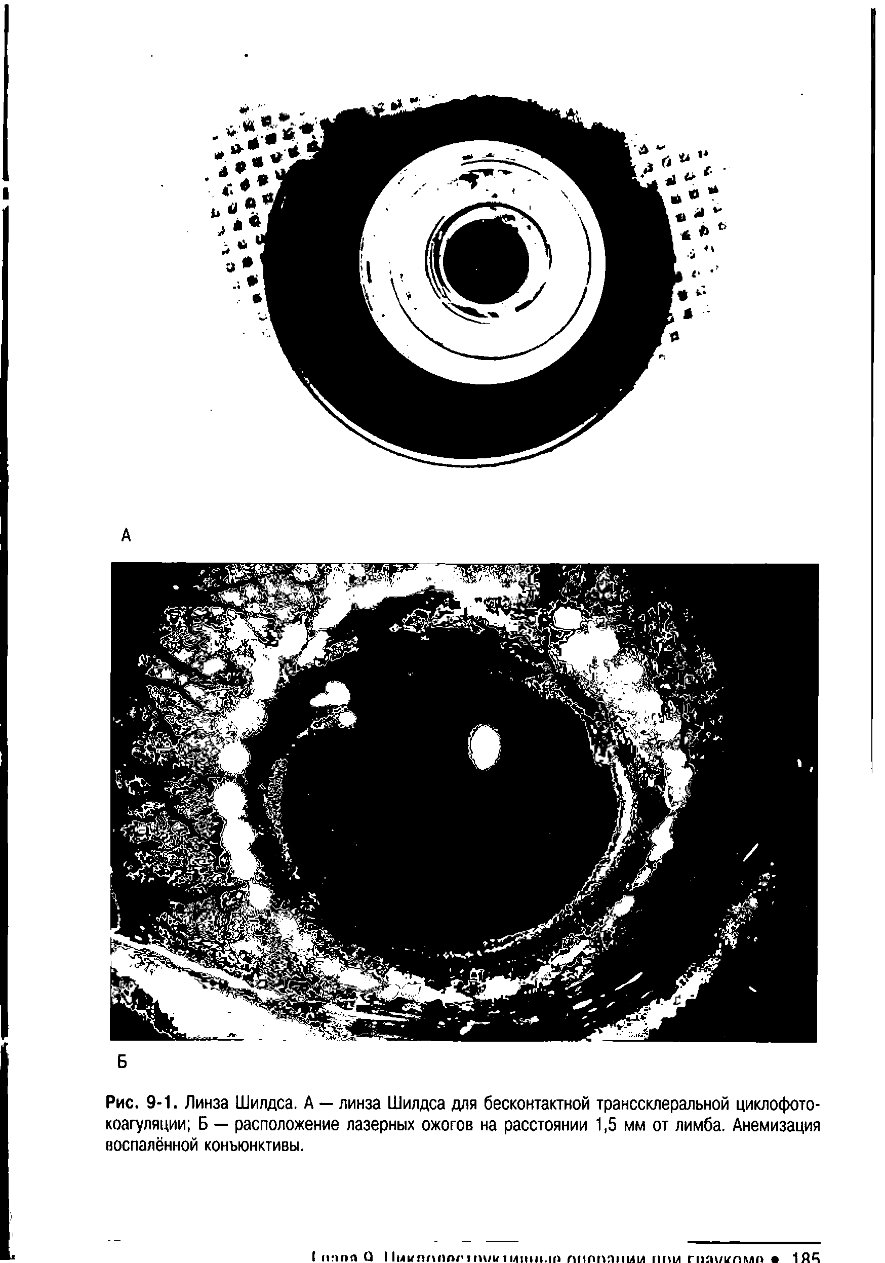 Рис. 9-1. Линза Шилдса. А — линза Шилдса для бесконтактной транссклеральной циклофотокоагуляции Б — расположение лазерных ожогов на расстоянии 1,5 мм от лимба. Анемизация воспалённой коньюнктивы.