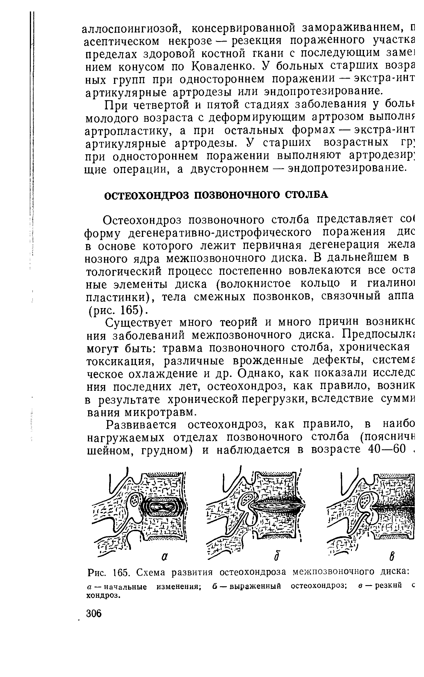 Рис. 165. Схема развития остеохондроза межпозвоночного диска а — начальные изменения б — выраженный остеохондроз в — резкий с хондроз.