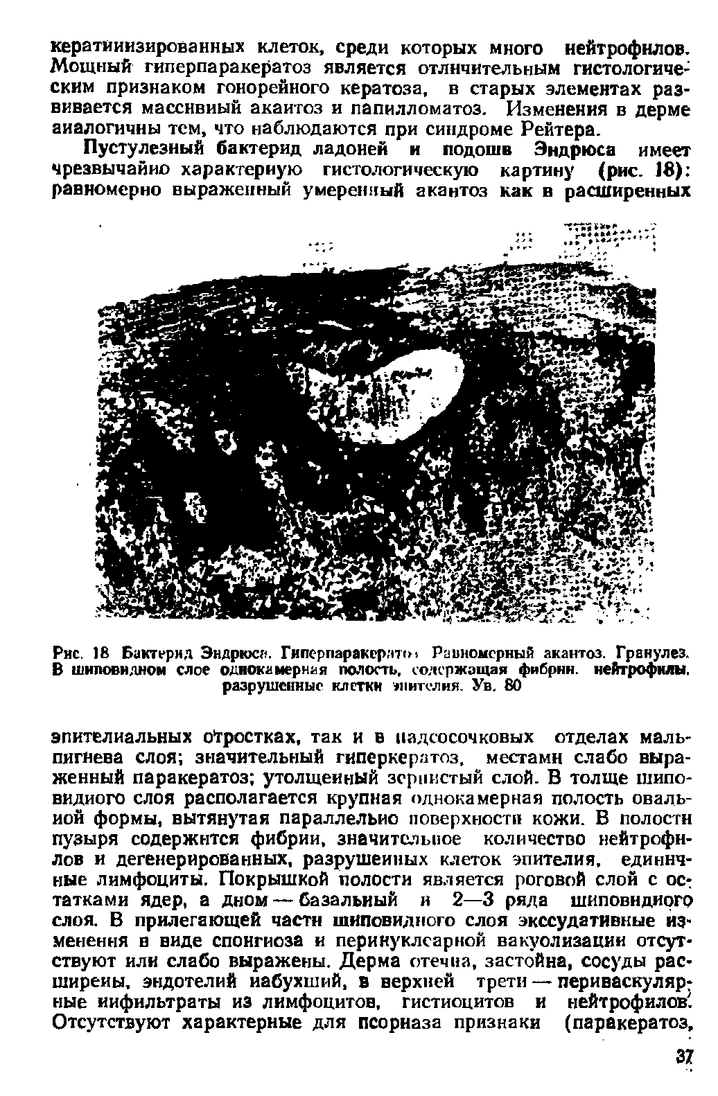 Рис. 18 Бактерид Эндрюс . Гипсрпаракер.пгм Равномерный акантоз. Гранулез. В шиловидном слое однокамерная полость, содержащая фибрин, нейтрофилы, разрушенные клетки эпителия. Ув. 80...