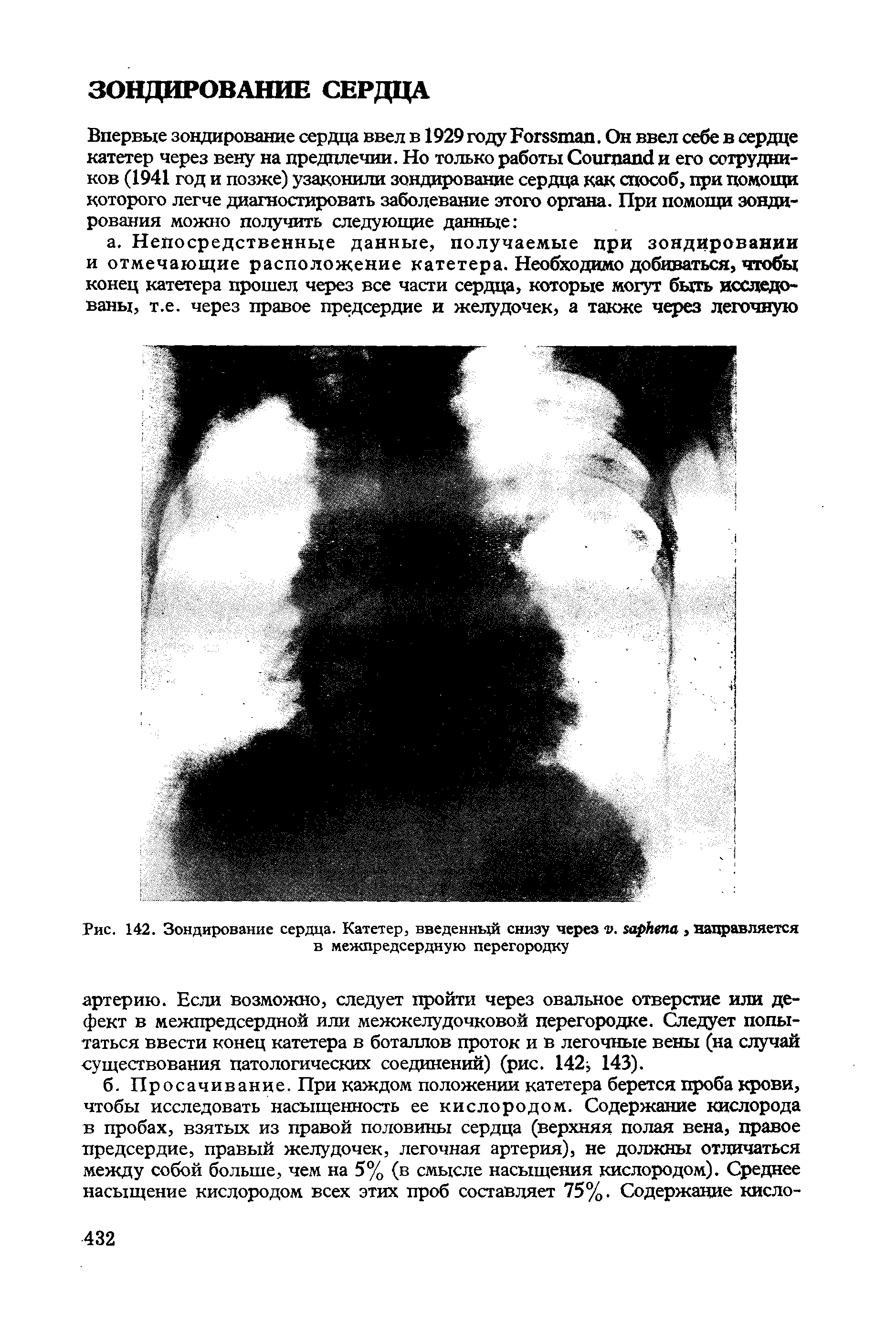 Рис. 142. Зондирование сердца. Катетер, введенный снизу через . , направляется в межпредсердную перегородку...