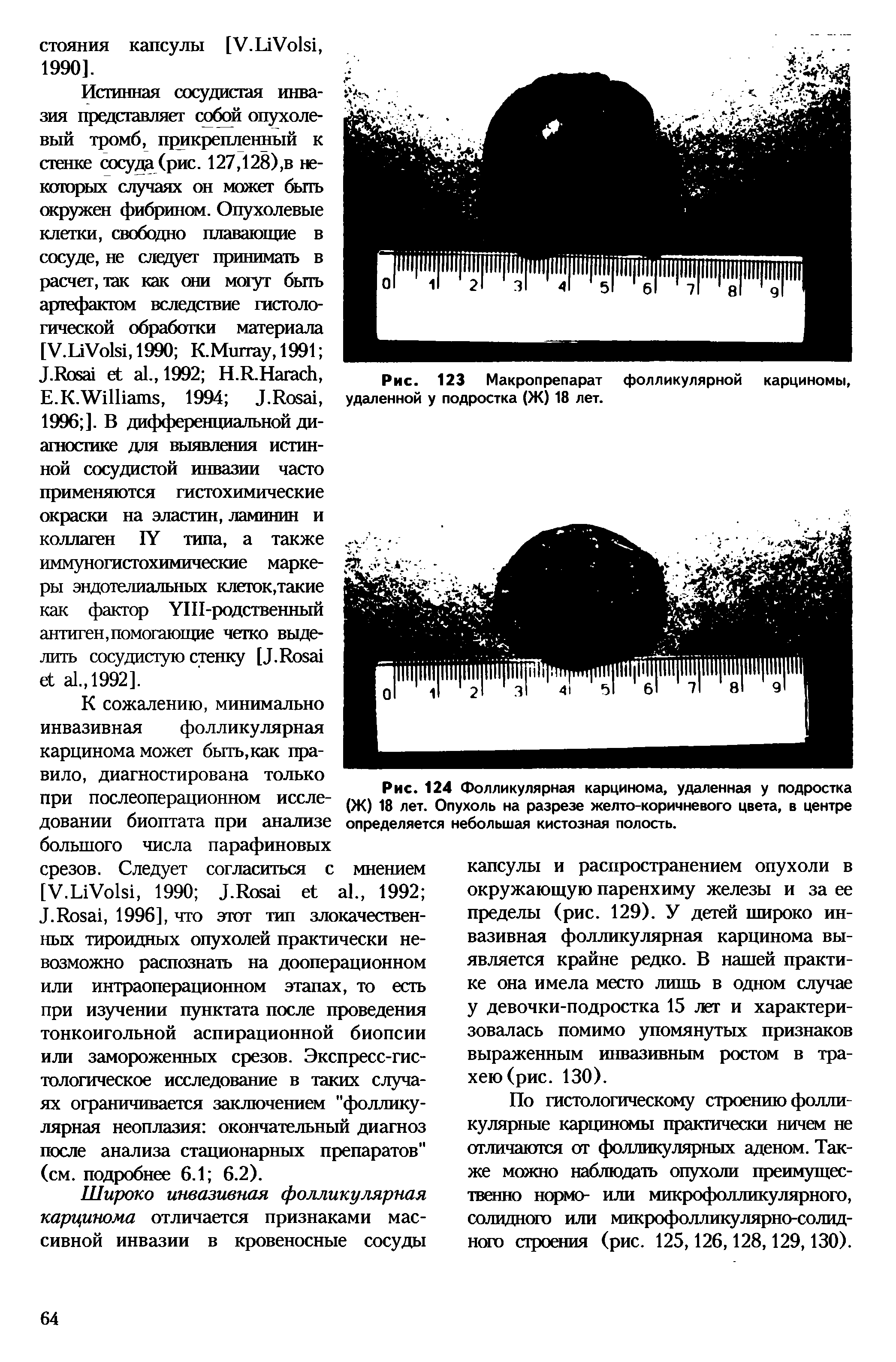 Рис. 124 Фолликулярная карцинома, удаленная у подростка (Ж) 18 лет. Опухоль на разрезе желто-коричневого цвета, в центре определяется небольшая кистозная полость.