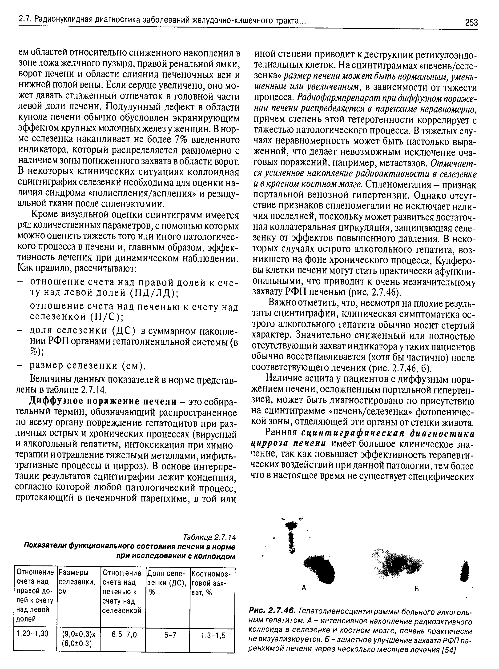 Рис. 2.7.46. Гепатолиеносцинтиграммы больного алкогольным гепатитом. А - интенсивное накопление радиоактивного коллоида в селезенке и костном мозге, печень практически не визуализируется. Б - заметное улучшение захвата РФП паренхимой печени через несколько месяцев лечения [54]...