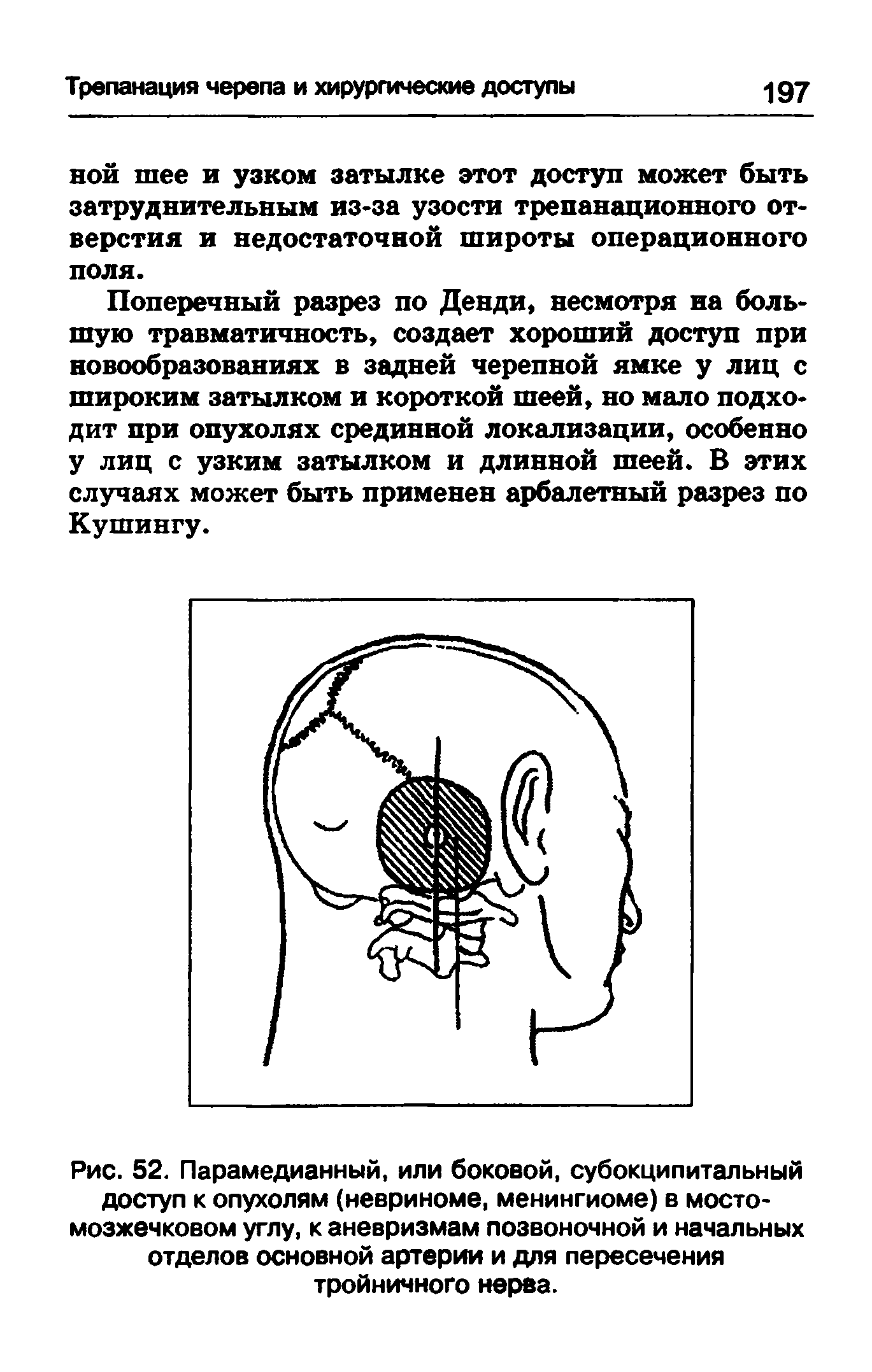 Рис. 52. Парамедианный, или боковой, субокципитальный доступ к опухолям (невриноме, менингиоме) в мостомозжечковом углу, к аневризмам позвоночной и начальных отделов основной артерии и для пересечения тройничного нерва.