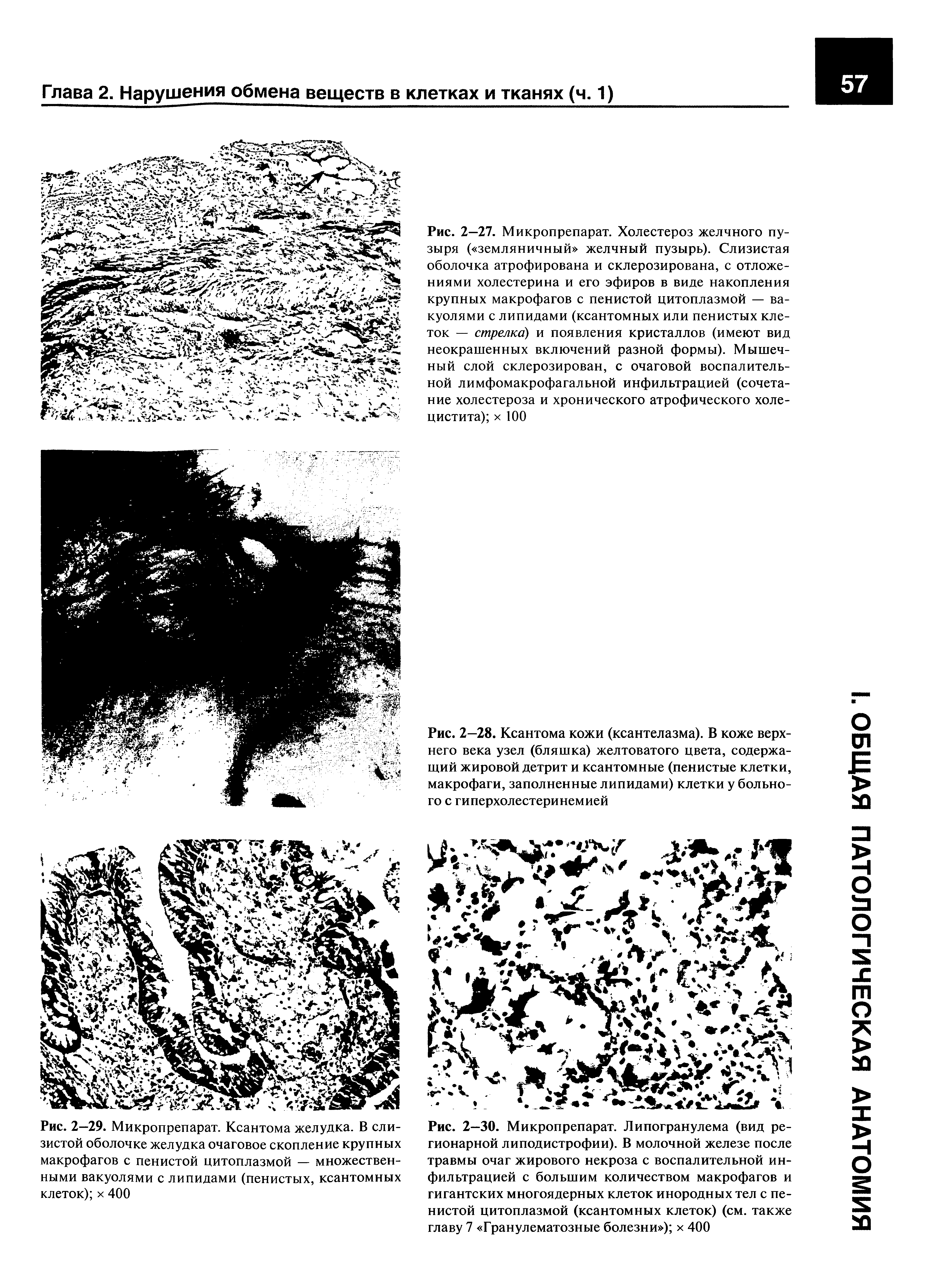 Рис. 2-28. Ксантома кожи (ксантелазма). В коже верхнего века узел (бляшка) желтоватого цвета, содержащий жировой детрит и ксантомные (пенистые клетки, макрофаги, заполненные липидами) клетки у больного с гиперхолестеринемией...