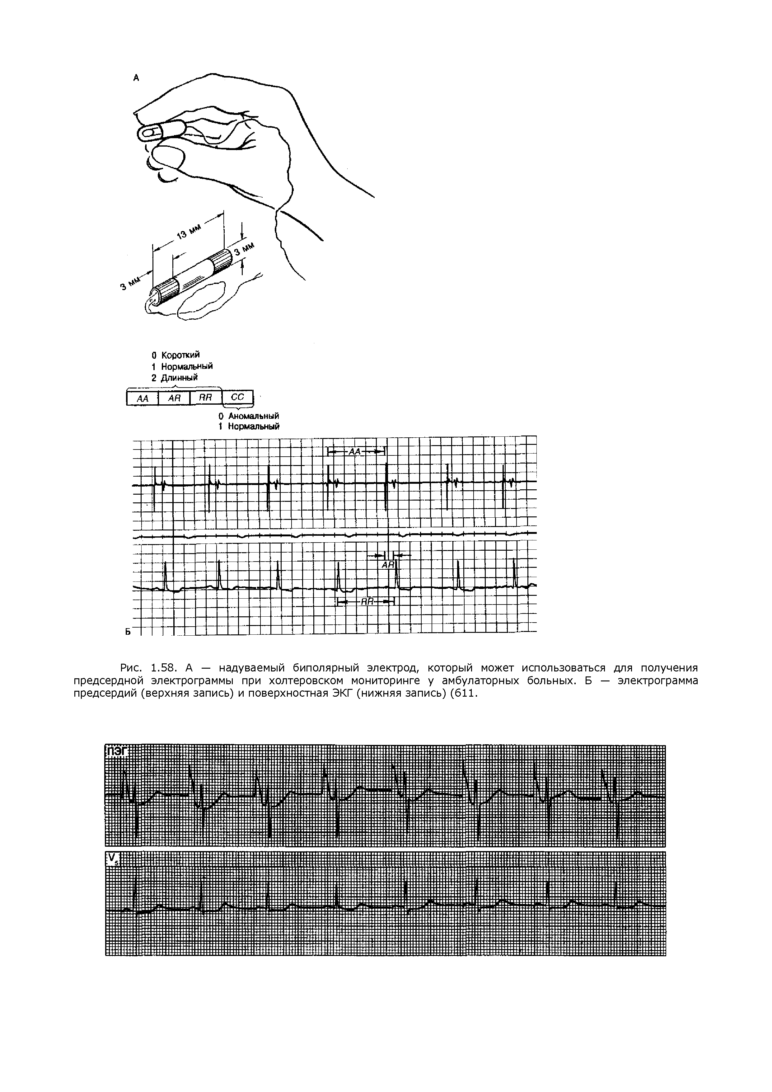 Рис. 1.58. А — надуваемый биполярный электрод, который может использоваться для получения предсердной электрограммы при холтеровском мониторинге у амбулаторных больных. Б — электрограмма предсердий (верхняя запись) и поверхностная ЭКГ (нижняя запись) (611.