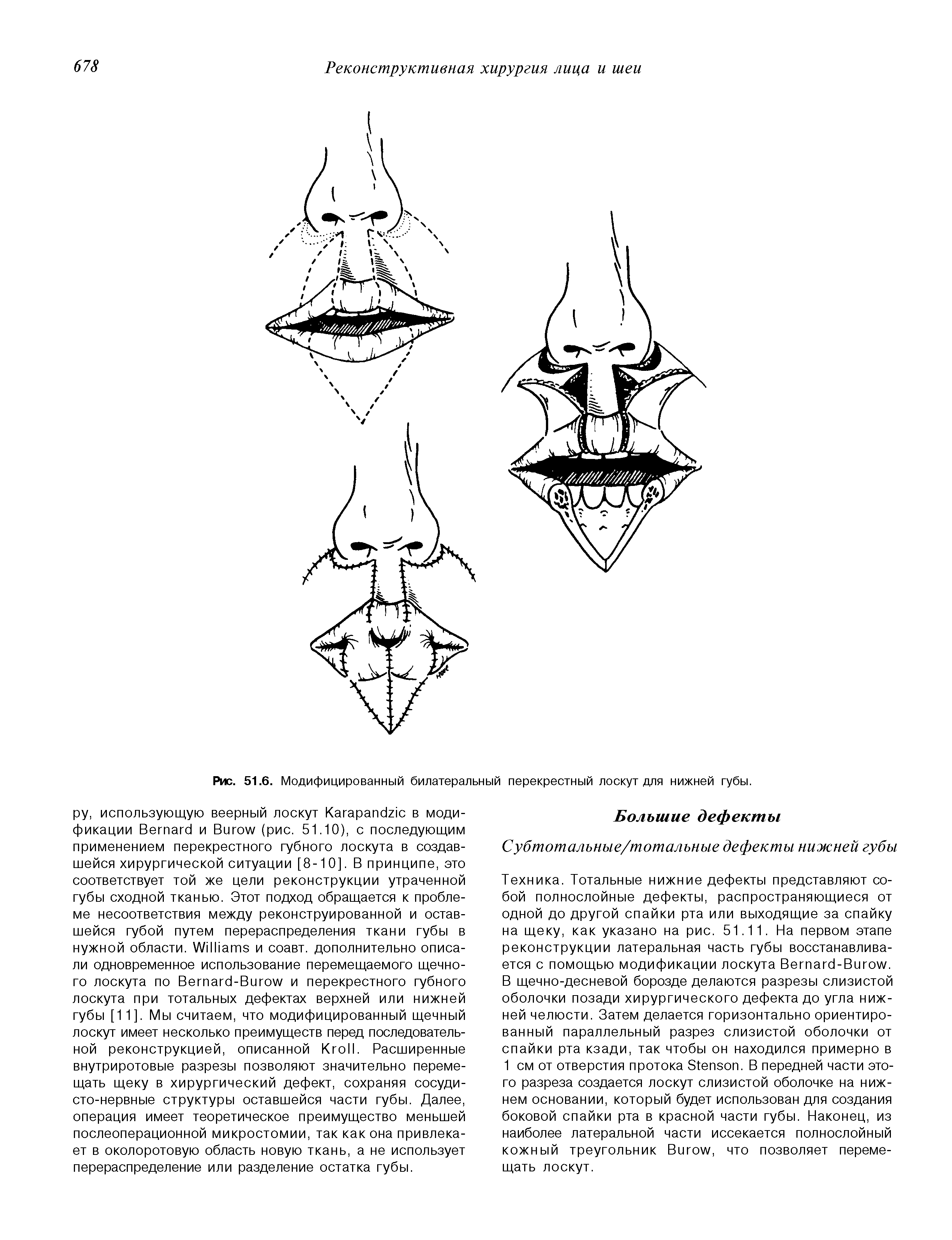 Рис. 51.6. Модифицированный билатеральный перекрестный лоскут для нижней губы.