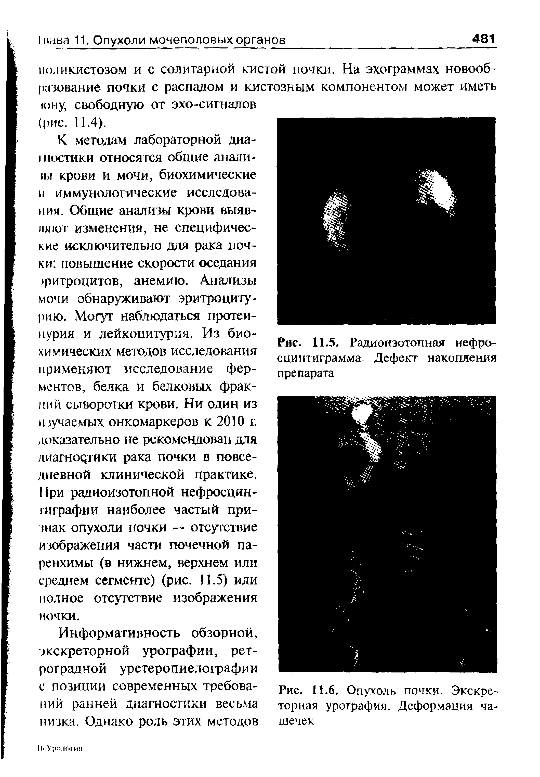 Рис. 11.6. Опухоль почки. Экскреторная урография. Деформация чашечек...