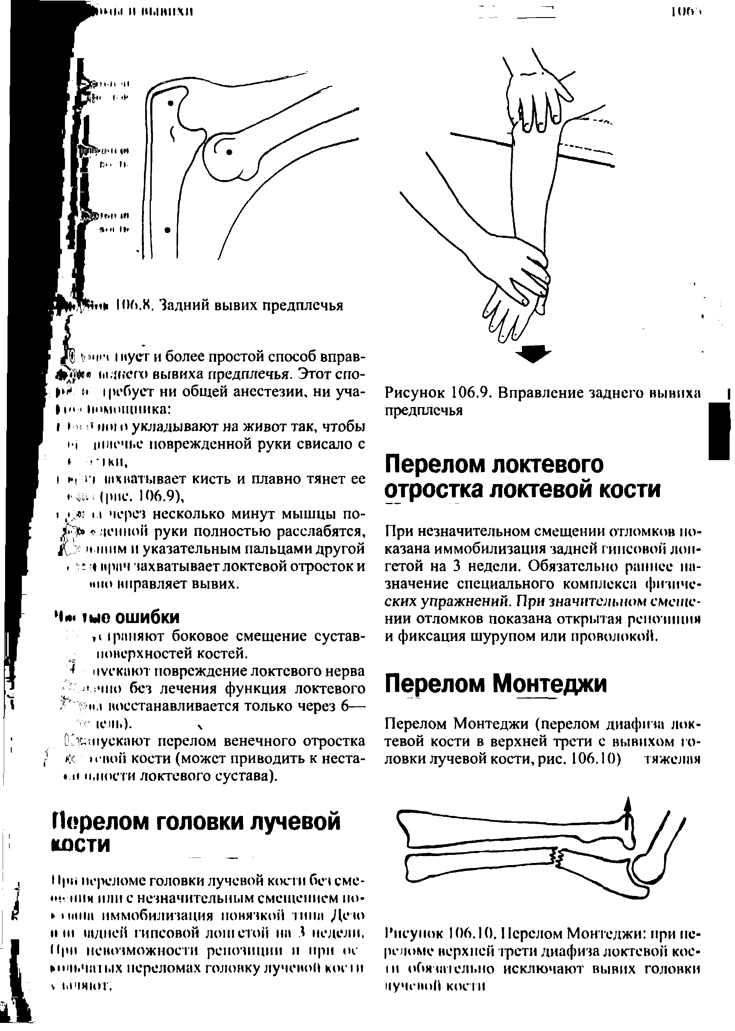 Рисунок 106.10, Перелом Монтеджи при переломе верхней трети диафиза локтевой кос-1И обязательно исключают вывих головки кучевой кости...