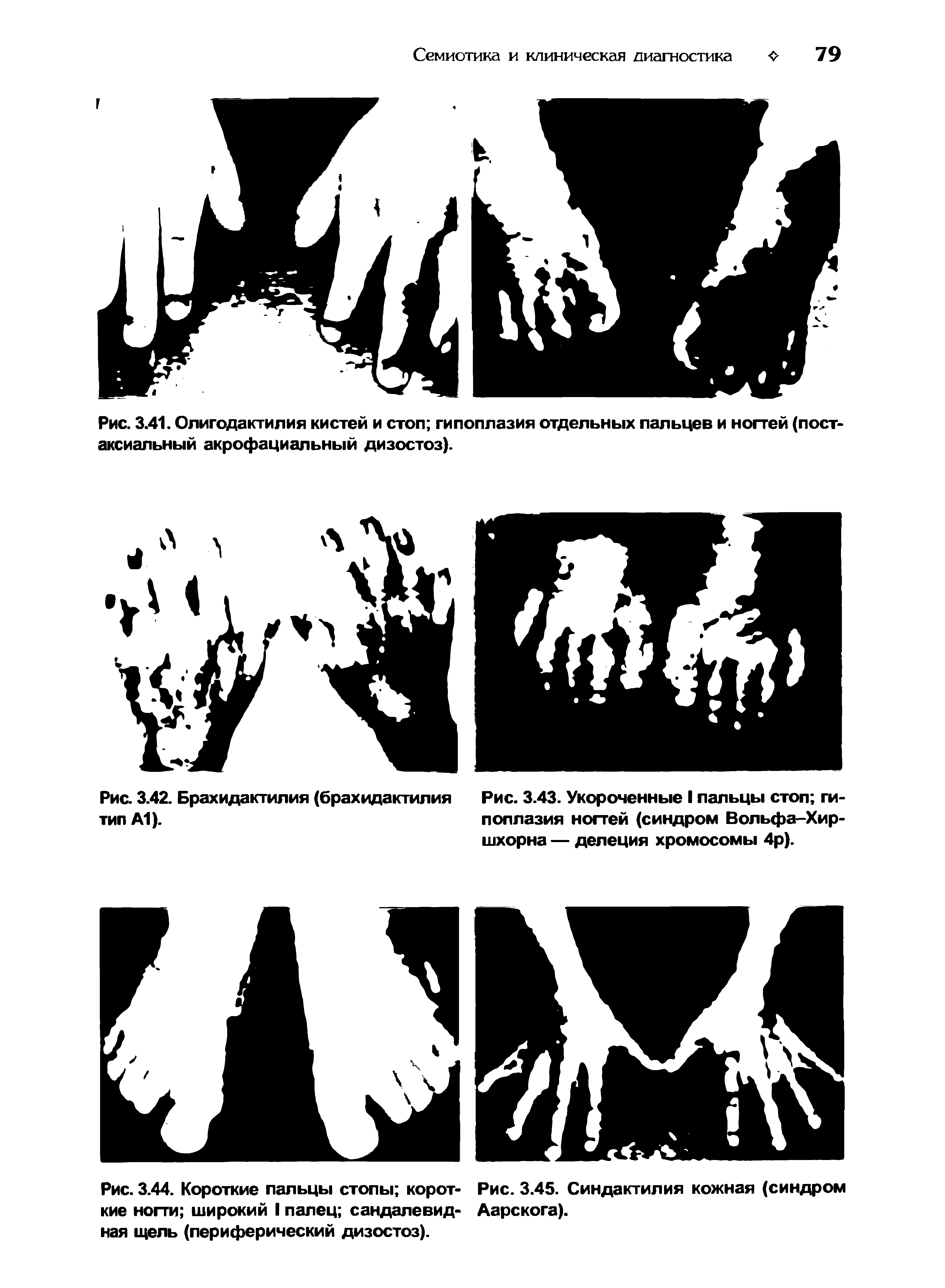 Рис. 3.44. Короткие пальцы стопы корот- Рис. 3.45. Синдактилия кожная (синдром кие ногти широкий I палец сандалевид- Аарскога).