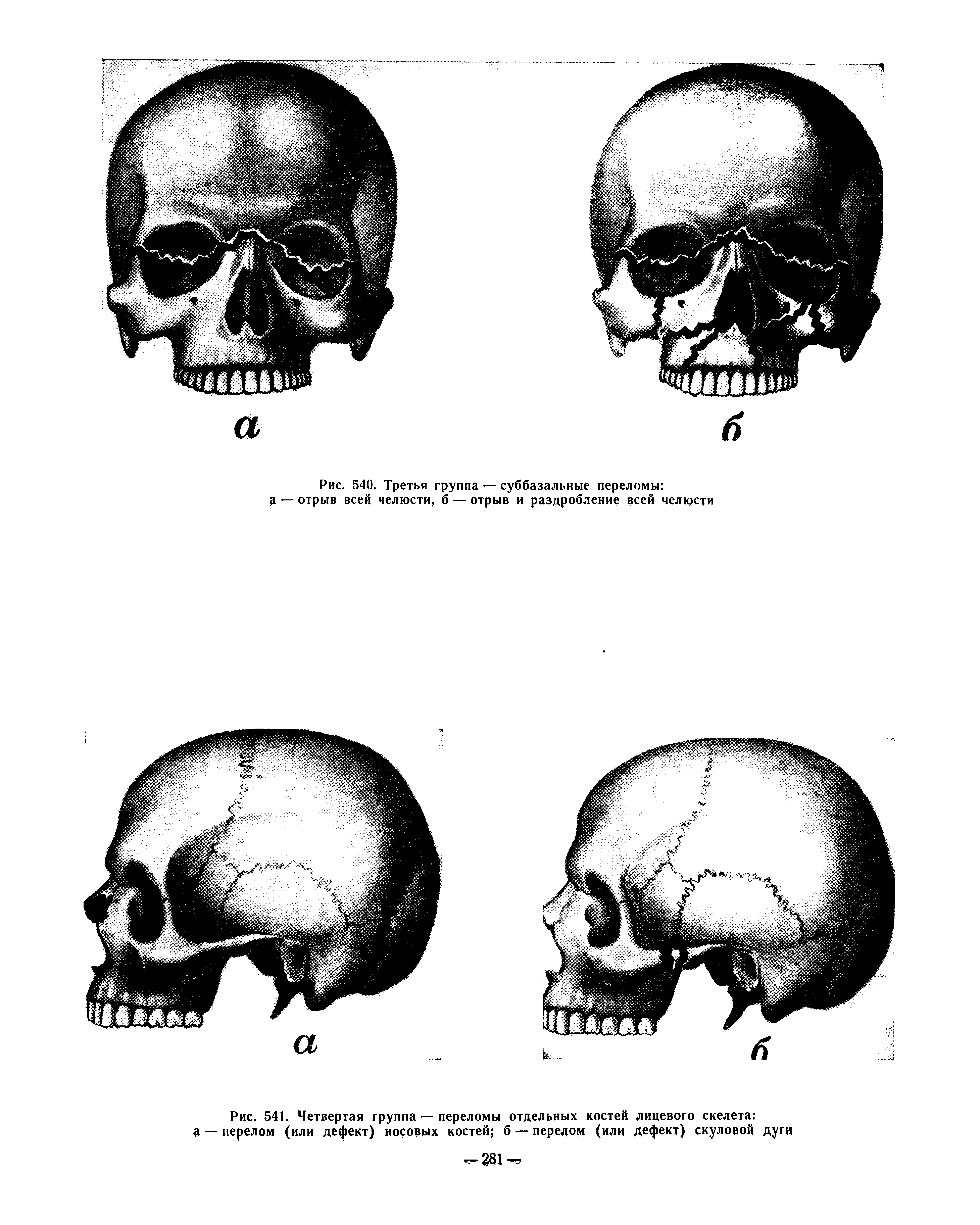 Рис. 541. Четвертая группа — переломы отдельных костей лицевого скелета д — перелом (или дефект) носовых костей б — передом (или дефект) скуловой дуги...