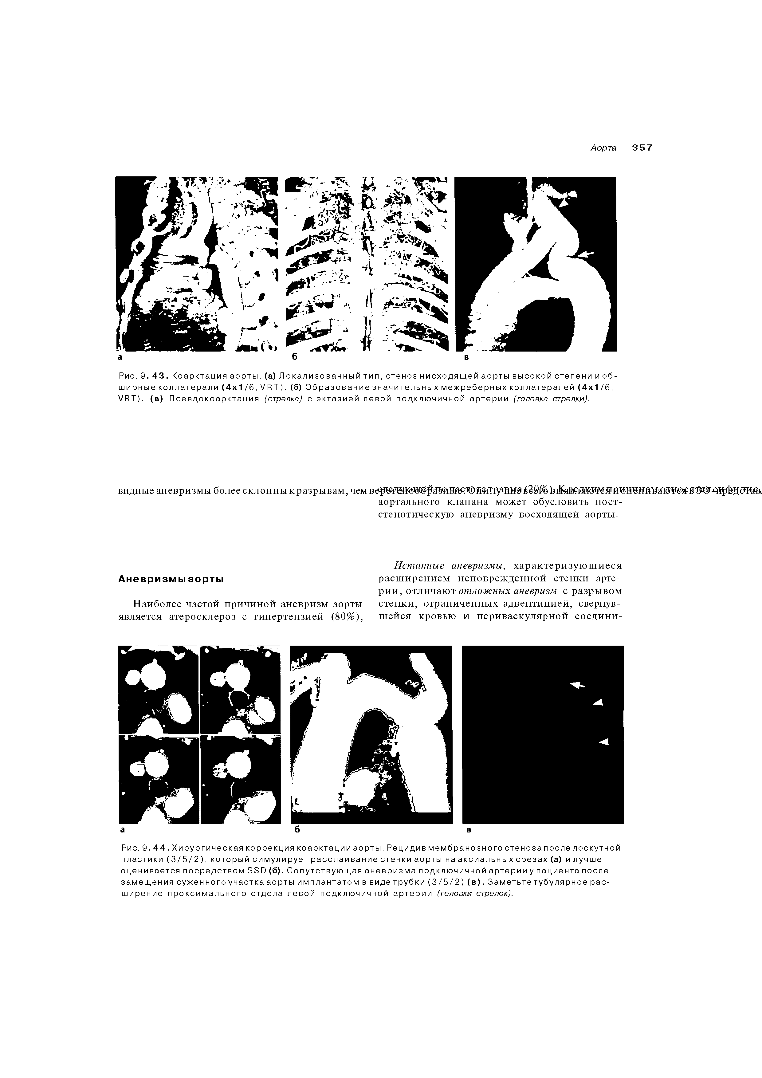 Рис. 9. 43. Коарктация аорты, (а) Локализованный тип, стеноз н исходя щей аорты высокой степени и обширные коллатерали (4 1/6, VЯТ). (б) Образованиезначительныхмежреберных коллатералей (4 1 / 6, Х/ЯТ). (в) Псевдокоарктация (стрелка) с эктазией левой подключичной артерии (головка стрелки).