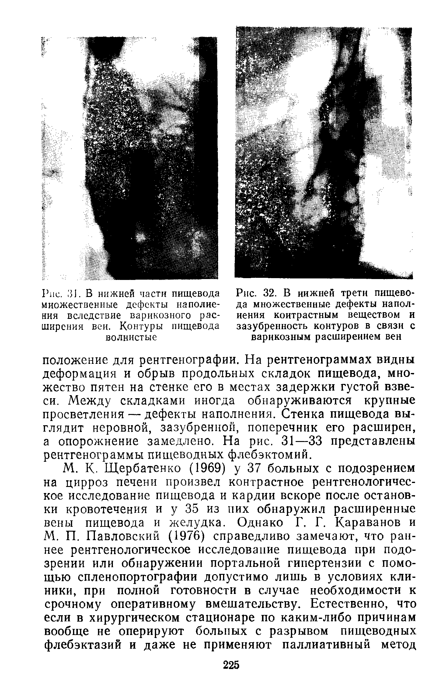 Рис. 31. В нижней части пищевода множественные дефекты наполнения вследствие варикозного расширения вей. Контуры пищевода волнистые...