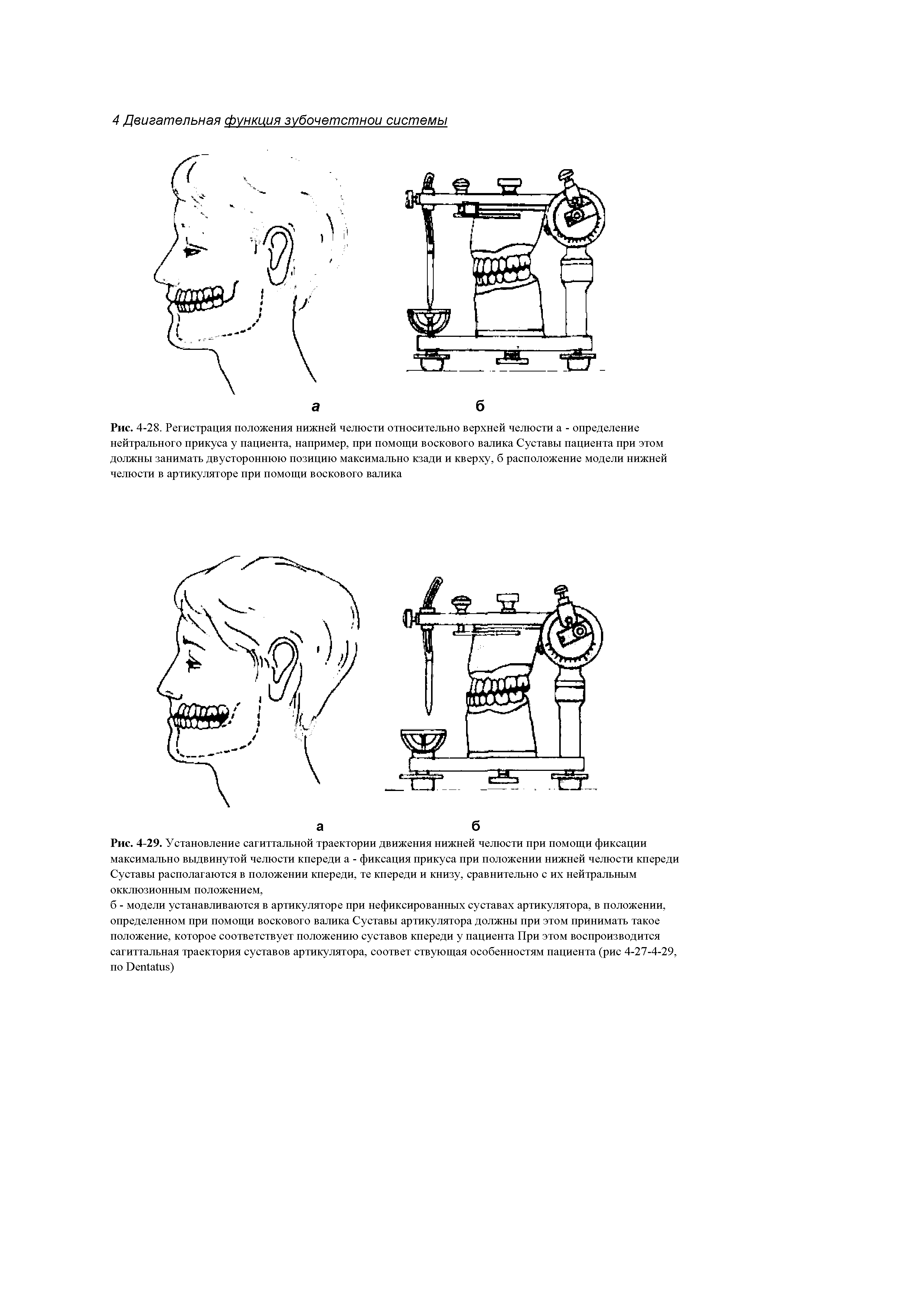 Рис. 4-29. Установление сагиттальной траектории движения нижней челюсти при помощи фиксации максимально выдвинутой челюсти кпереди а - фиксация прикуса при положении нижней челюсти кпереди Суставы располагаются в положении кпереди, те кпереди и книзу, сравнительно с их нейтральным...
