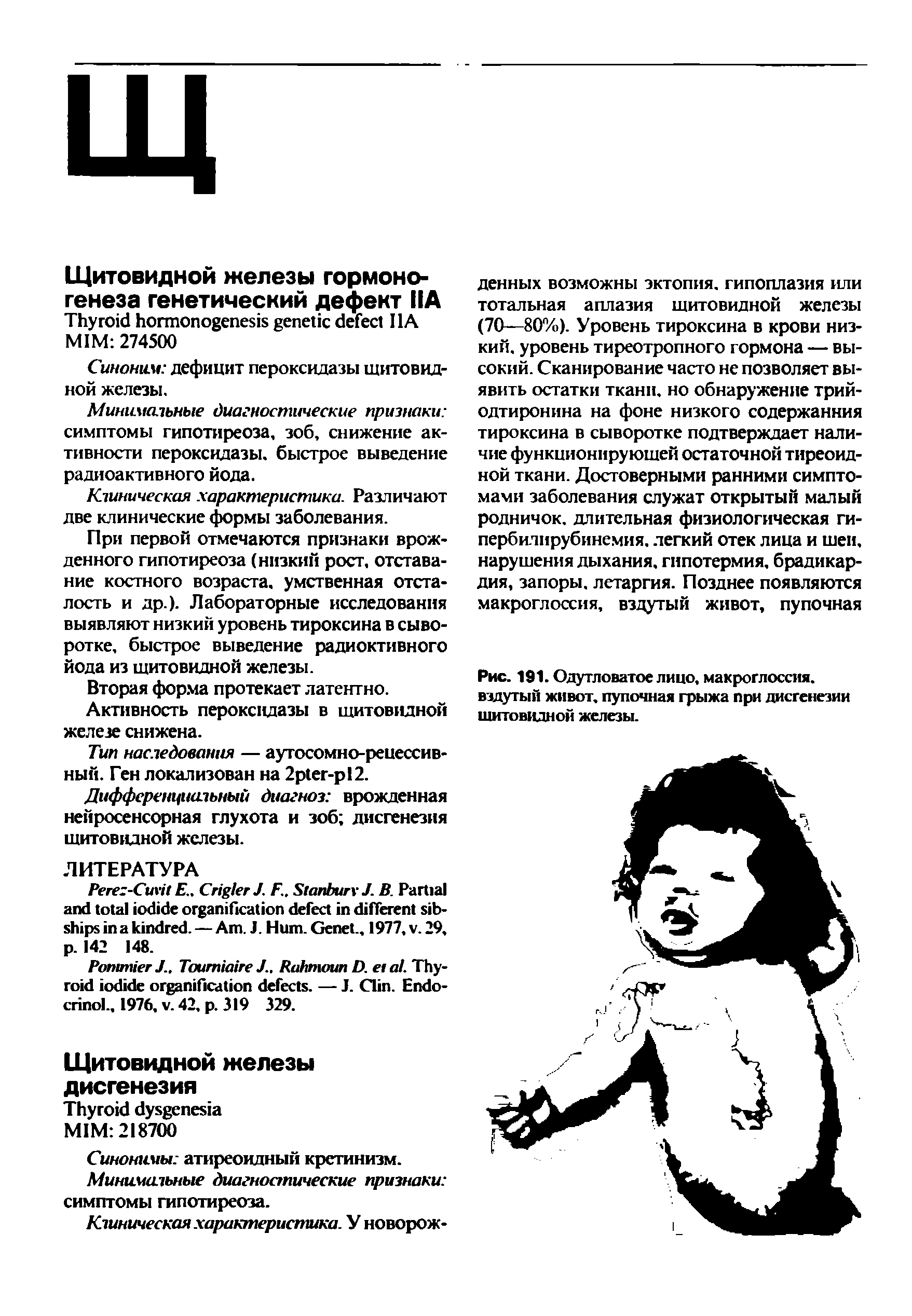 Рис. 191. Одутловатое лицо, макроглоссия. вздутый живот, пупочная грыжа при дисгенезии щитовидной железы.