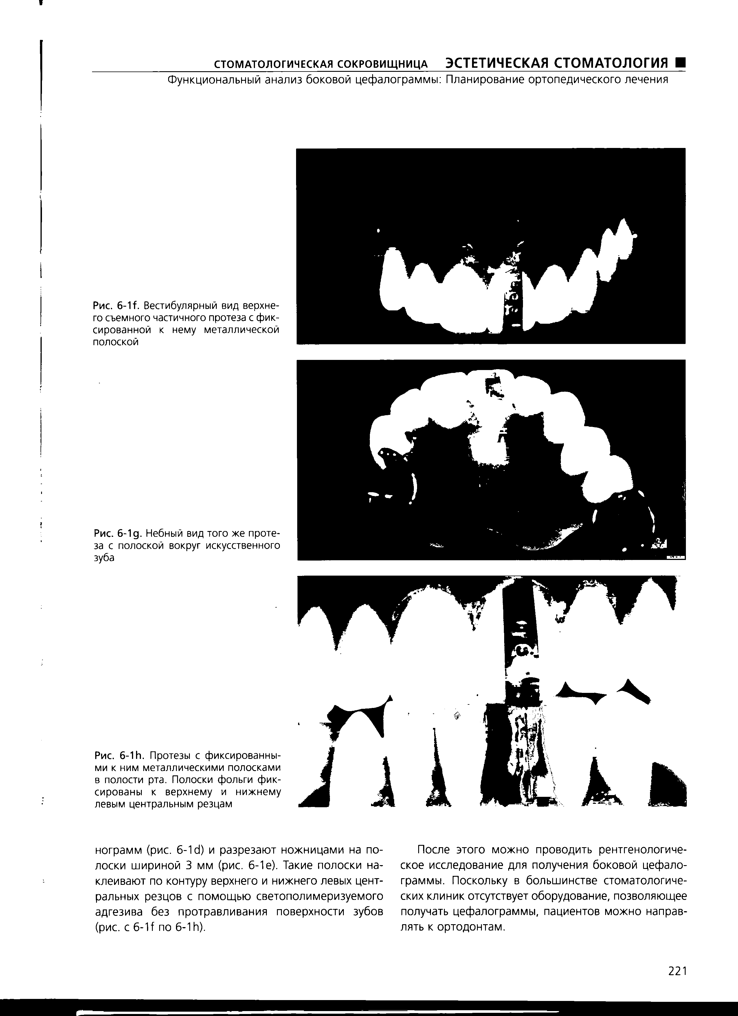Рис. 6-1 И. Протезы с фиксированными к ним металлическими полосками в полости рта. Полоски фольги фиксированы к верхнему и нижнему левым центральным резцам...