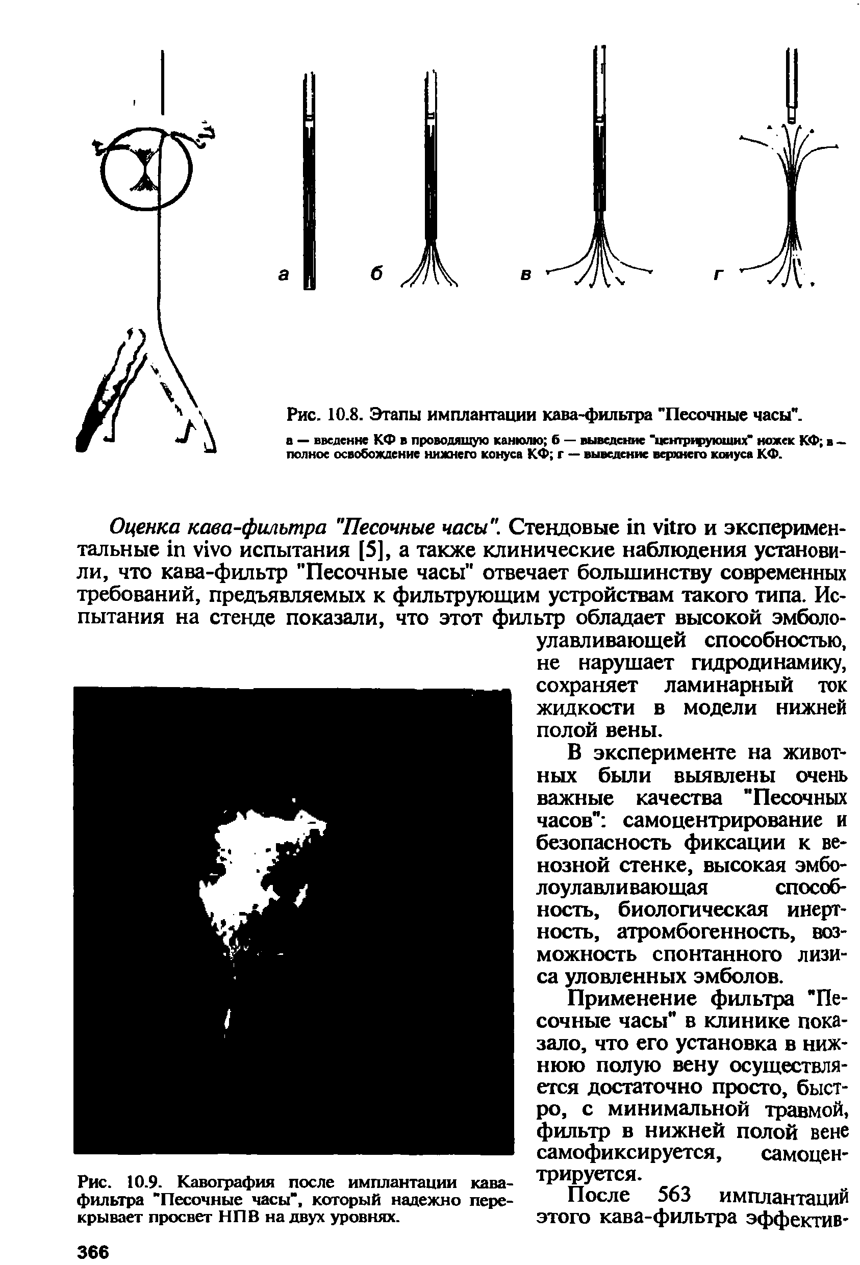 Рис. 10.9. Кавография после имплантации кава-фильтра "Песочные часы", который надежно перекрывает просвет НПВ на двух уровнях.