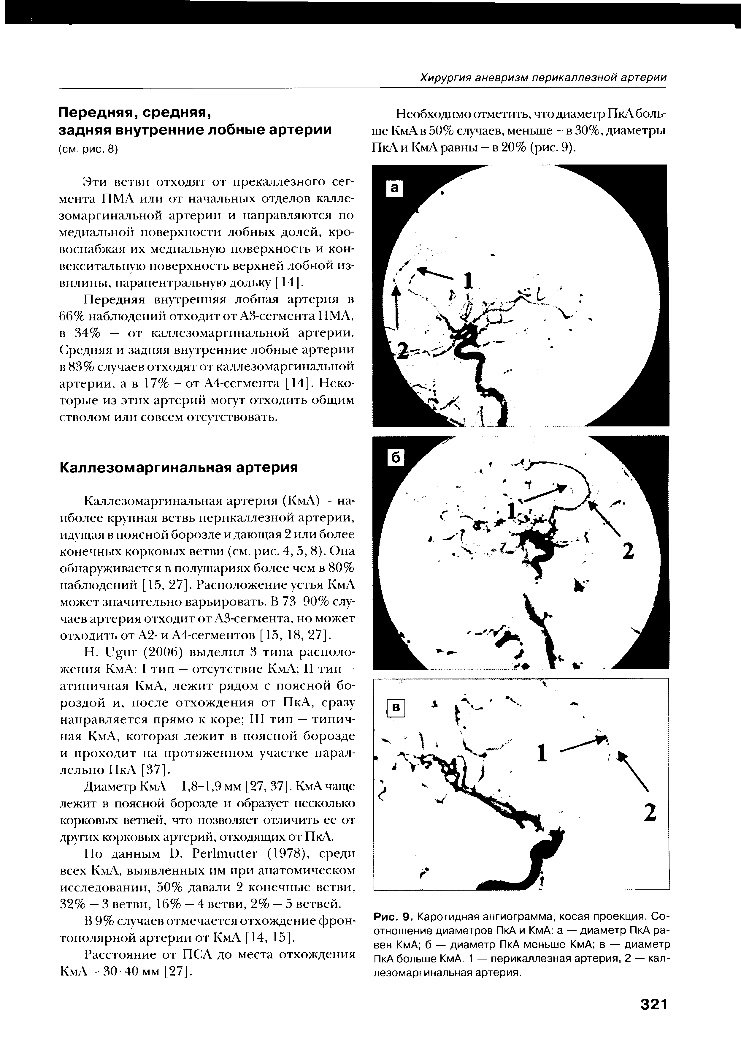 Рис. 9. Каротидная ангиограмма, косая проекция. Соотношение диаметров ПкА и КмА а — диаметр ПкА равен КмА б — диаметр ПкА меньше КмА в — диаметр ПкА больше КмА. 1 — перикаллезная артерия, 2 — каллезомаргинальная артерия.