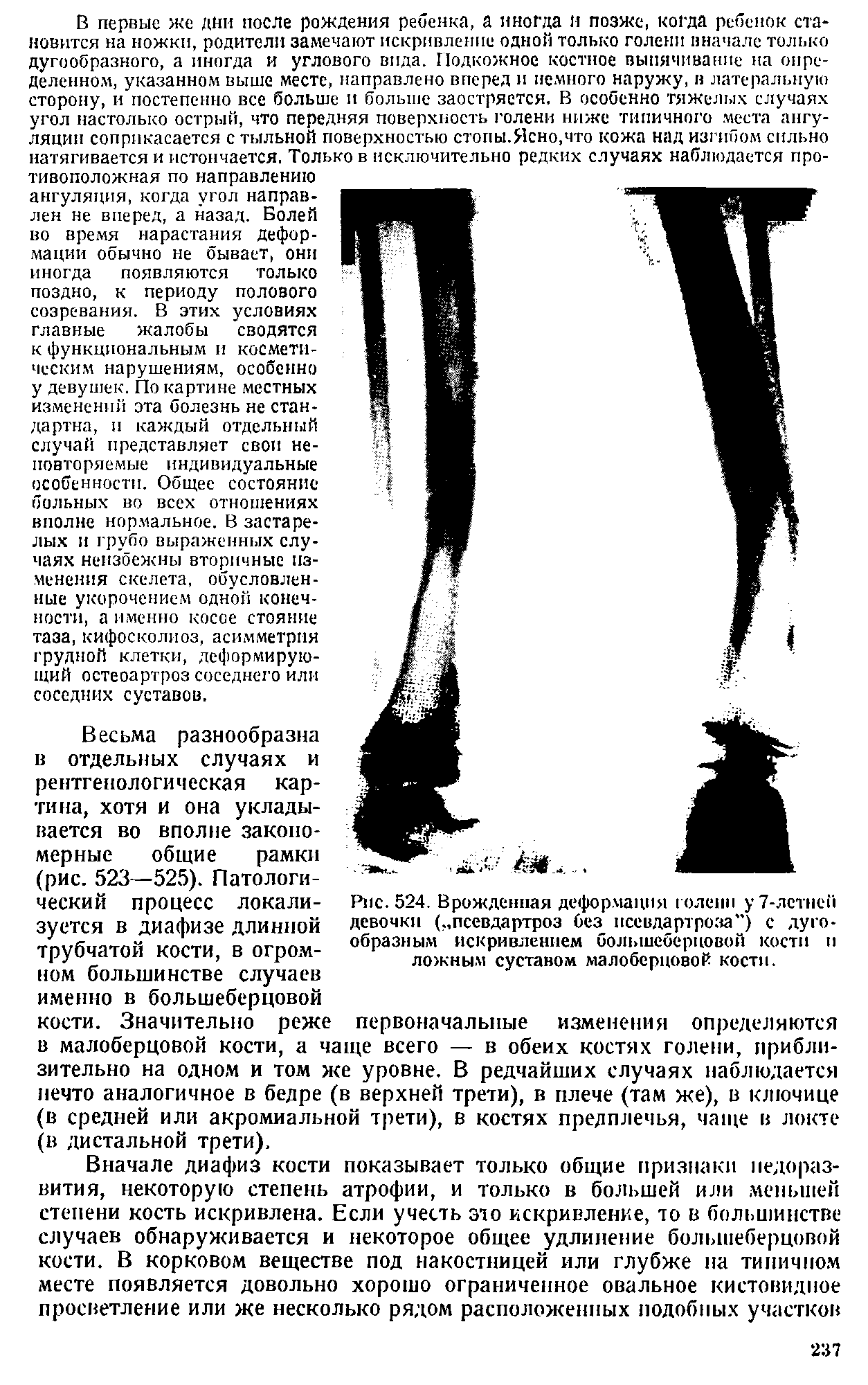 Рис. 524. Врожденная деформация голени у 7-лстнсй девочки ( псевдартроз без псевдартроза") с дугообразным искривлением большеберцовой кости и ложным суставом малоберцовой кости.