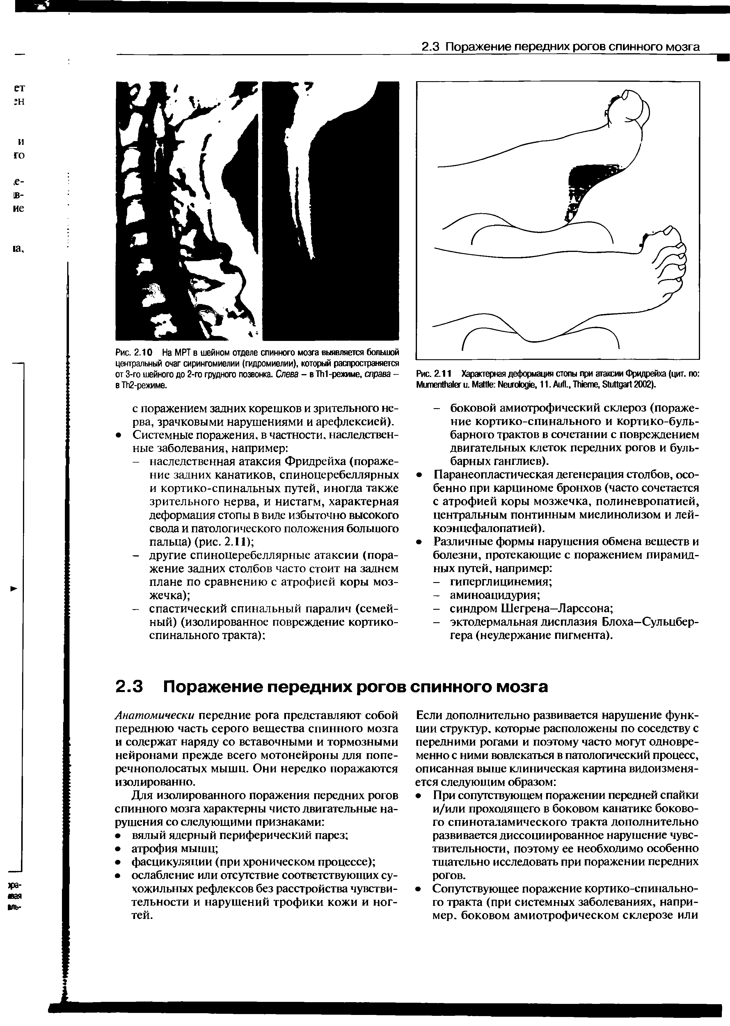 Рис. 2.11 Характерная деформация стопы при атаксии Фридрейха (цит. по M . M N , 11. A ., T , S 2002).