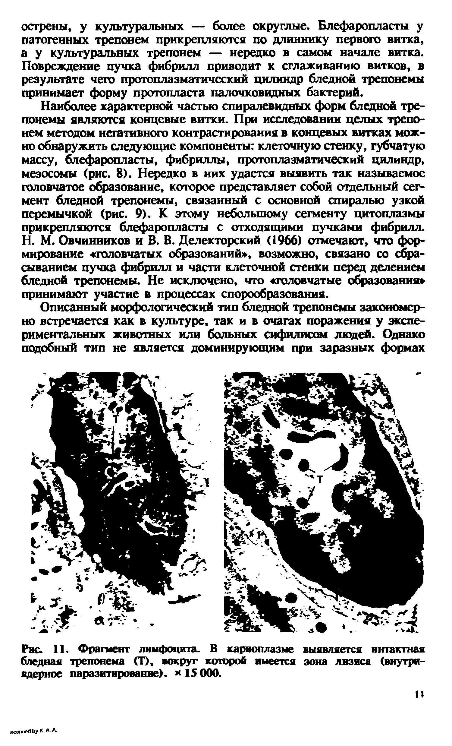 Рис. 11. Фрагмент лимфоцита. В кариоплазме выявляется интактная бледная трепонема <Г), вокруг которой имеется зона лизиса (внутриядерное паразитирование). х 15 000.