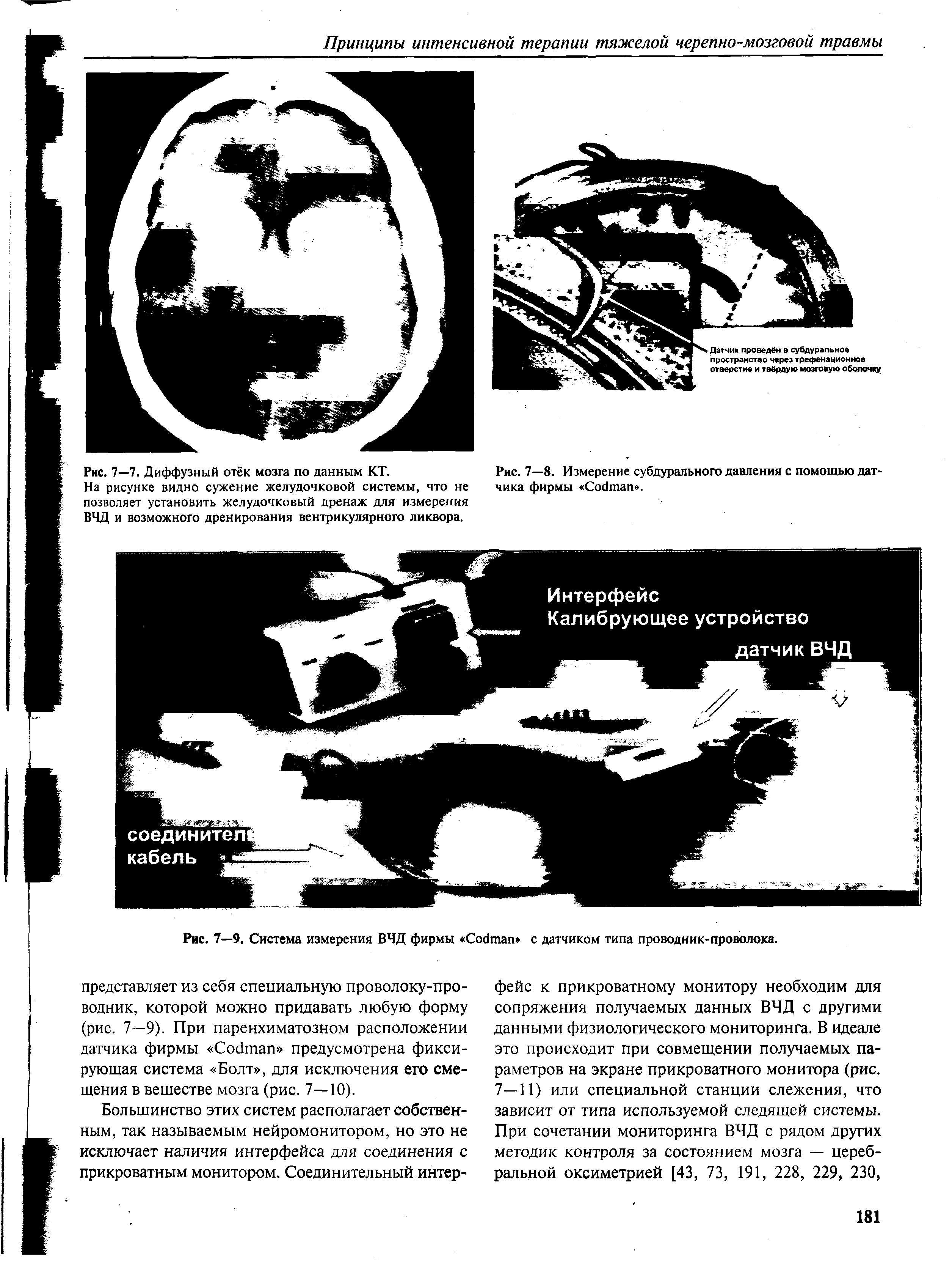 Рис. 7—8. Измерение субдурального давления с помощью датчика фирмы СоДтап .