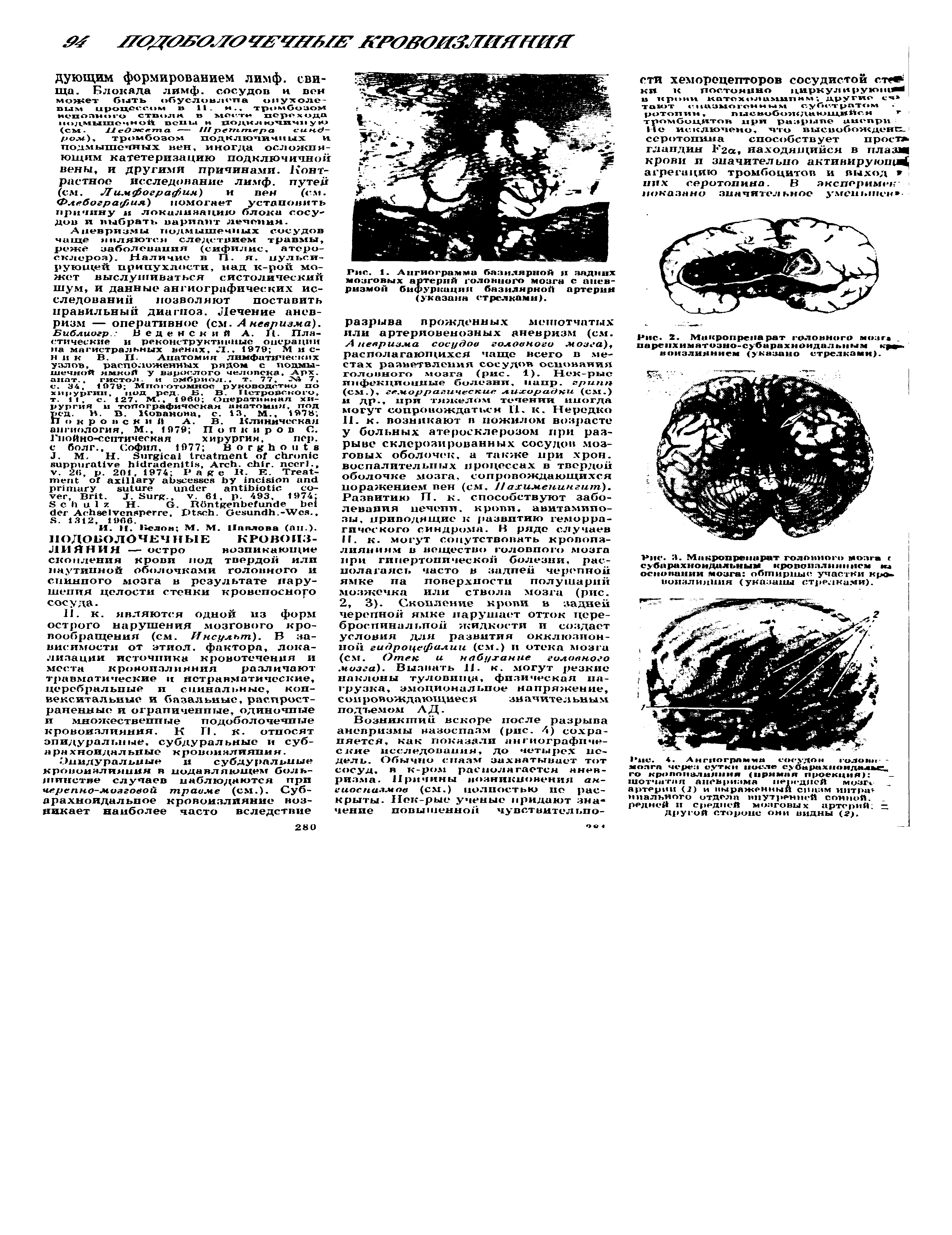 Рис. 1. Ангиограмма базилярной н задних мозговых артерий головного мозга с аневризмой бифуркация базилярной артерии (указана стрелками).