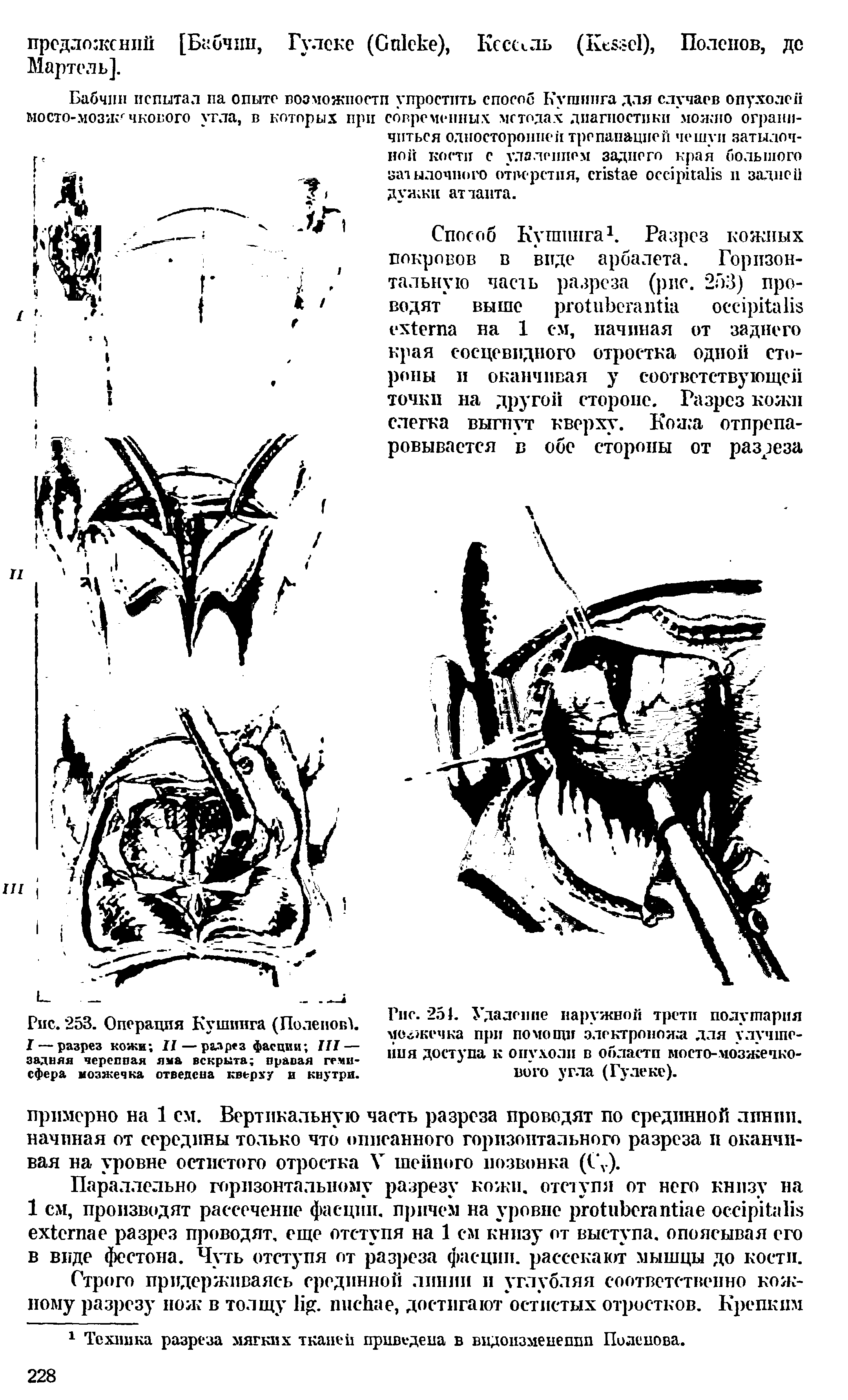 Рис. 253. Операция Кушинга (ПоленовУ I— разрез кожи II—разрез фасции III — задняя черепная яма вскрыта правая гемисфера мозжечка отведена кверху и кнутри.