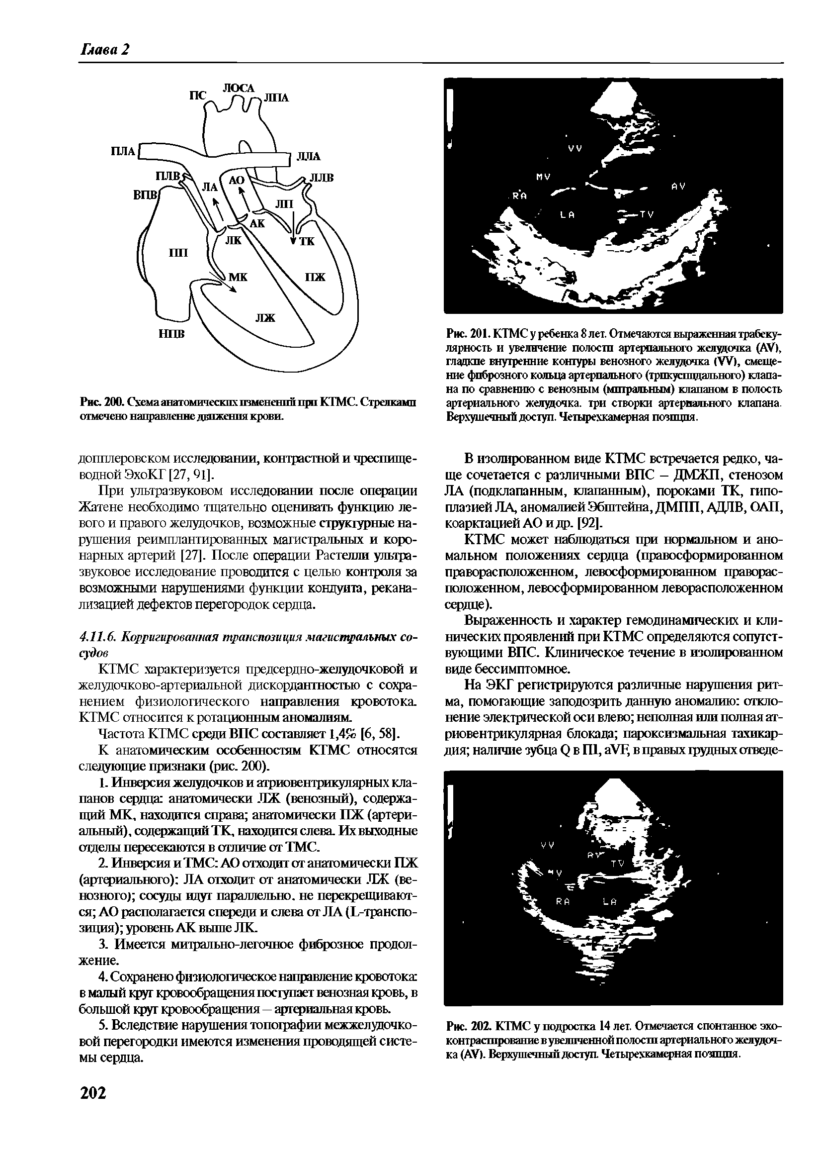 Рис. 202. КТМС у подростка 14 лет. Отмечается спонтанное эхо-контрастирование в увеличенной полости артериального желудочка (АУ). Верхушечный доступ. Четырехкамерная позиция.