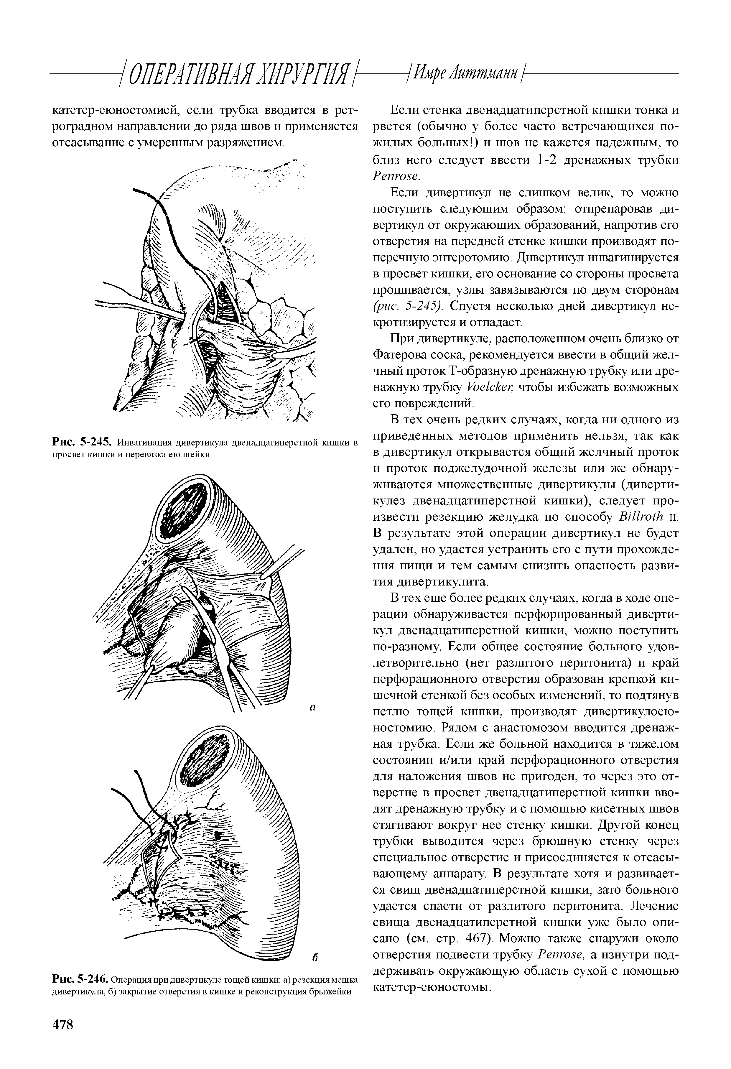 Рис. 5-246. Операция при дивертикуле тощей кишки а) резекция мешка дивертикула, б) закрытие отверстия в кишке и реконструкция брыжейки...