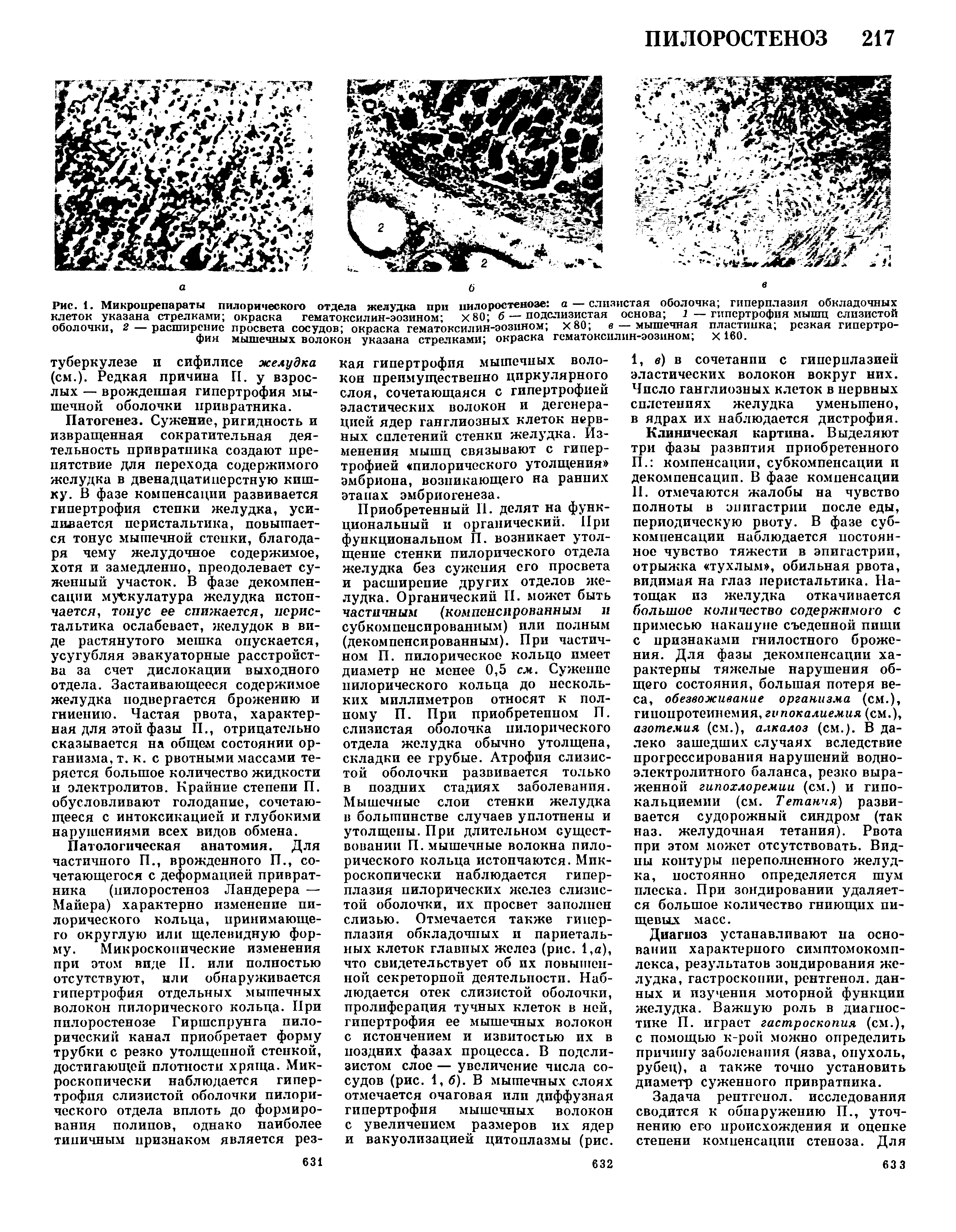 Рис. 1. Микропрепараты пилорического отдела желудка при пилоростенозе а — слизистая оболочка гиперплазия обкладочных клеток указана стрелками окраска гематоксилин-эозином х80 б — подслизистая основа 1 гипертрофия мышц слизистой...