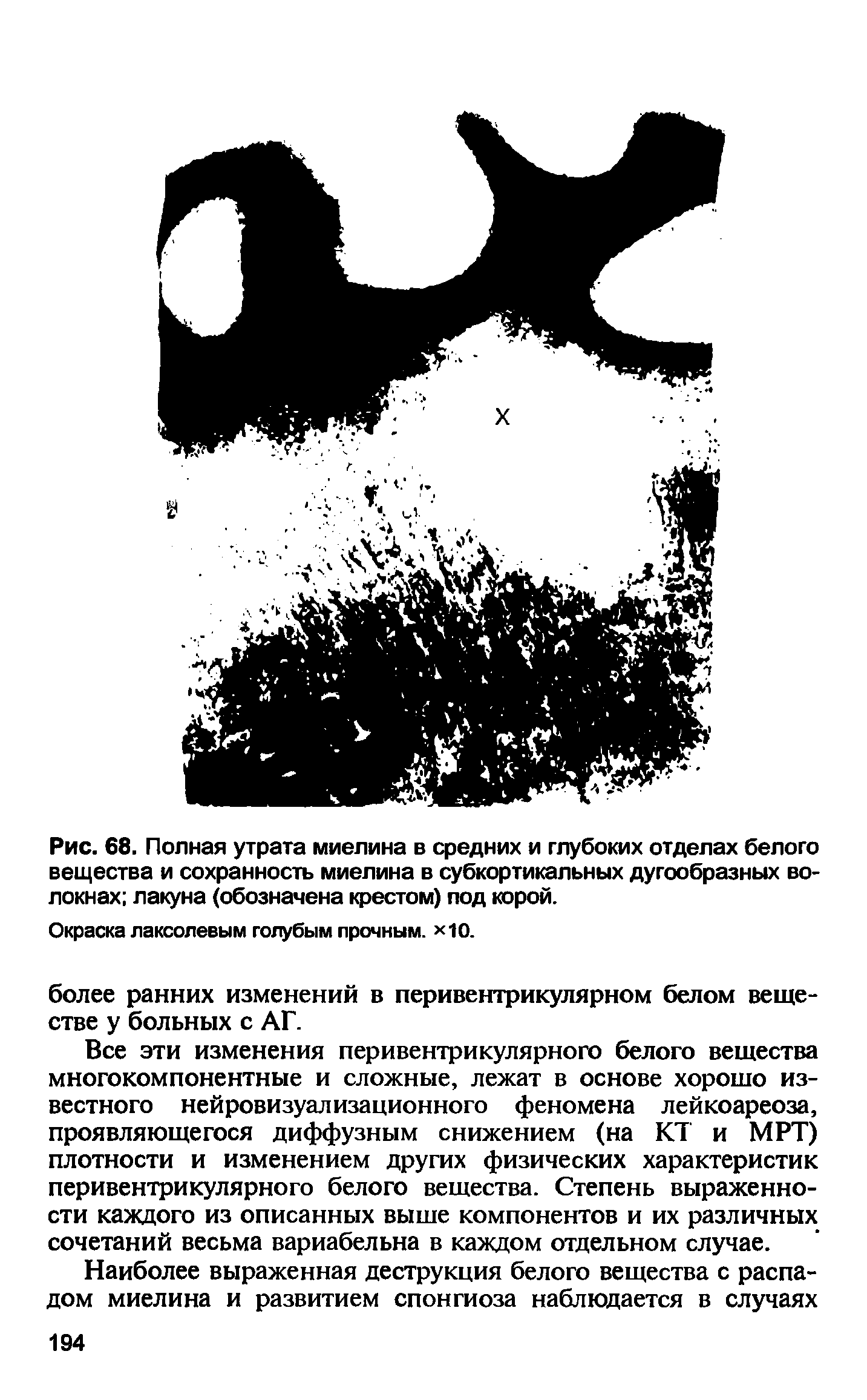 Рис. 68. Полная утрата миелина в средних и глубоких отделах белого вещества и сохранность миелина в субкортикальных дугообразных волокнах лакуна (обозначена крестом) под корой.