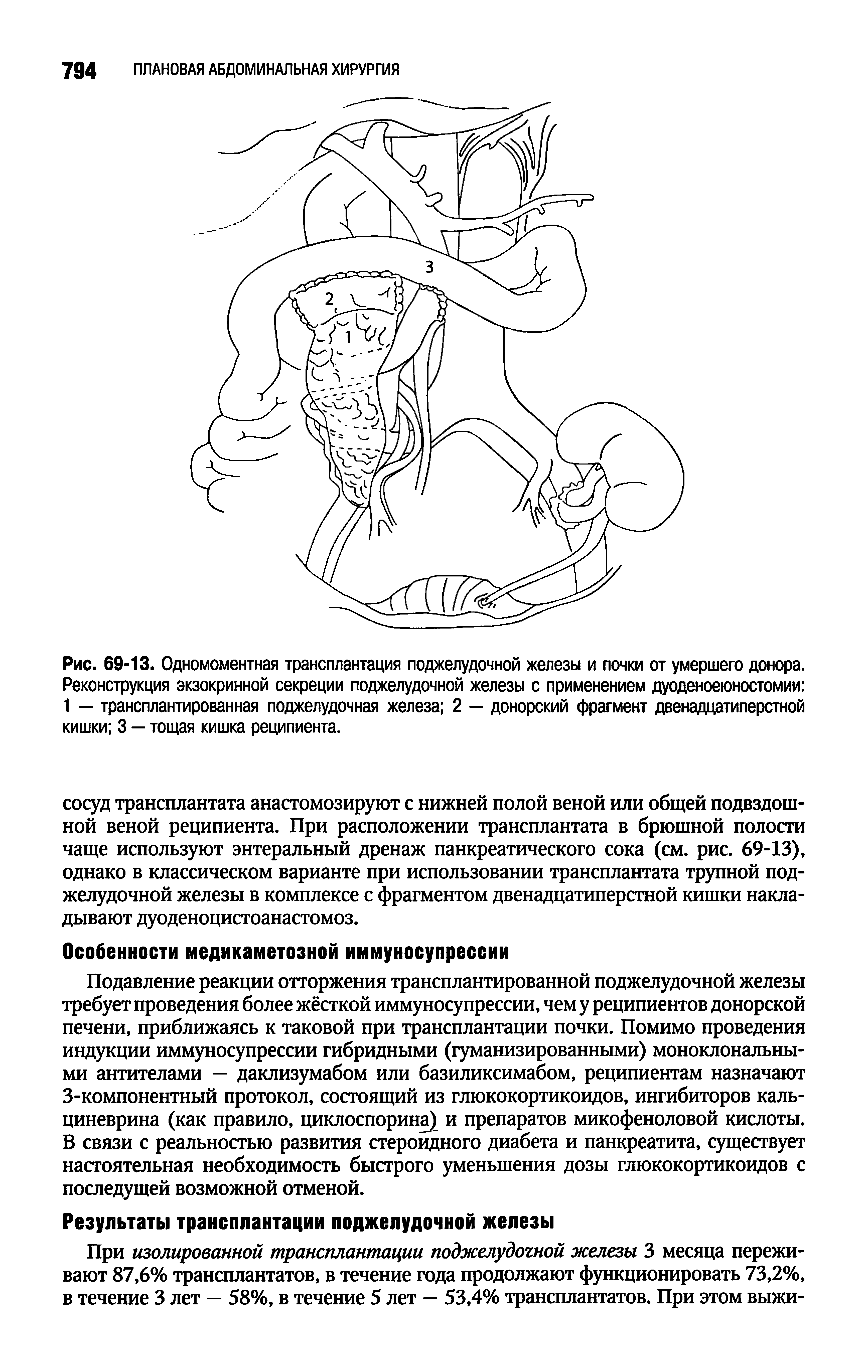 Рис. 69-13. Одномоментная трансплантация поджелудочной железы и почки от умершего донора. Реконструкция экзокринной секреции поджелудочной железы с применением дуоденоеюностомии 1 — трансплантированная поджелудочная железа 2 — донорский фрагмент двенадцатиперстной кишки 3 — тощая кишка реципиента.